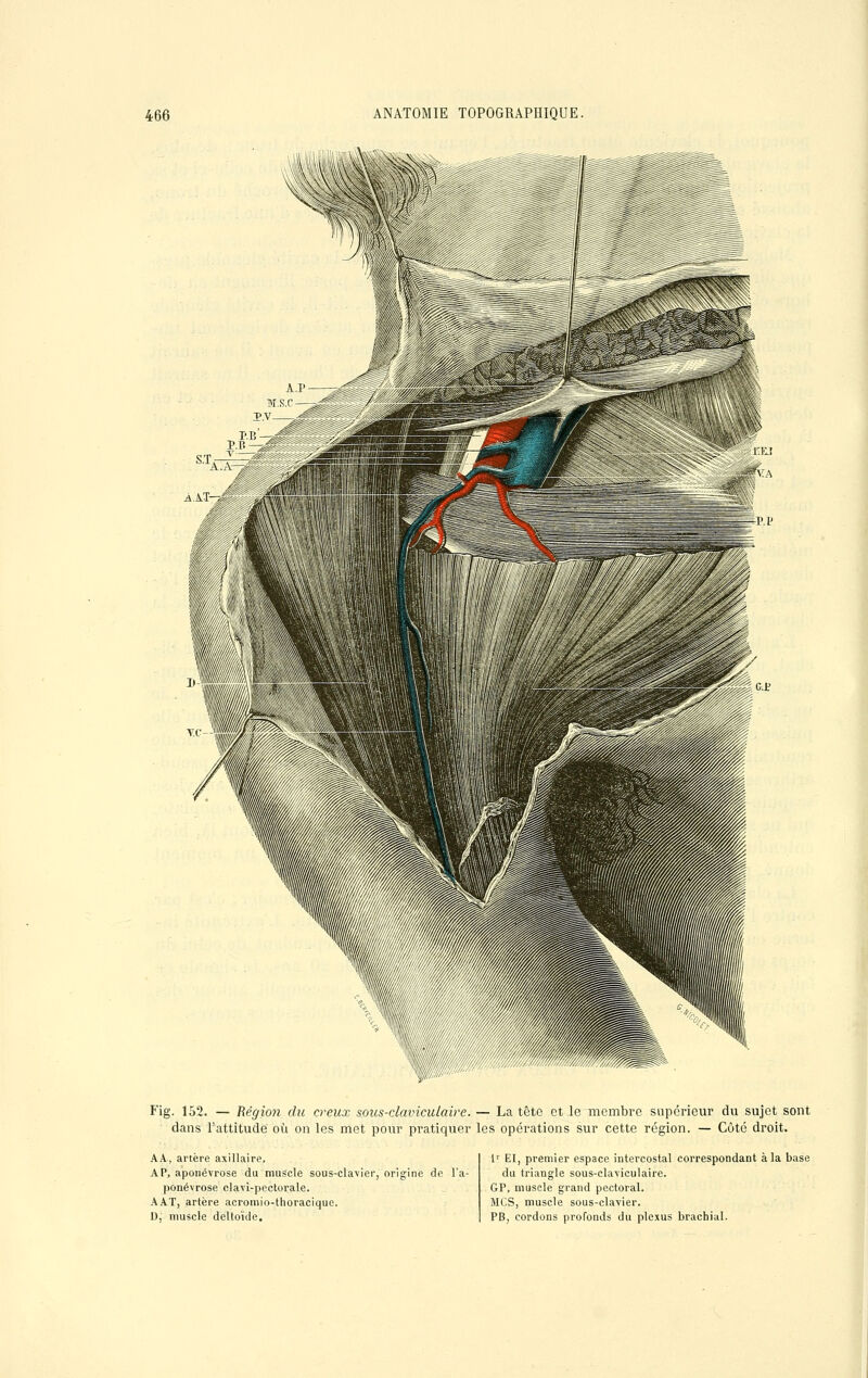 Fig. 152. — Région du creux sous-clainculaire. — La têto et le membre supérieur du sujet sont dans l'attitude où on les met pour pratiquer les opérations sur cette région. — Côté droit. AA, artère axillaire. AP, aponévrose du muscle sous-clavier, origine de l'a- ponévrose clavl-pectorale. A AT, artère acromio-thoracique. 0, muscle deltoïde. lv El, premier espace intercostal correspondant à la base du triangle sous-claviculaire. GP, muscle grand pectoral. MCS, muscle sous-clavier. PB, cordons profonds du plexus brachial.