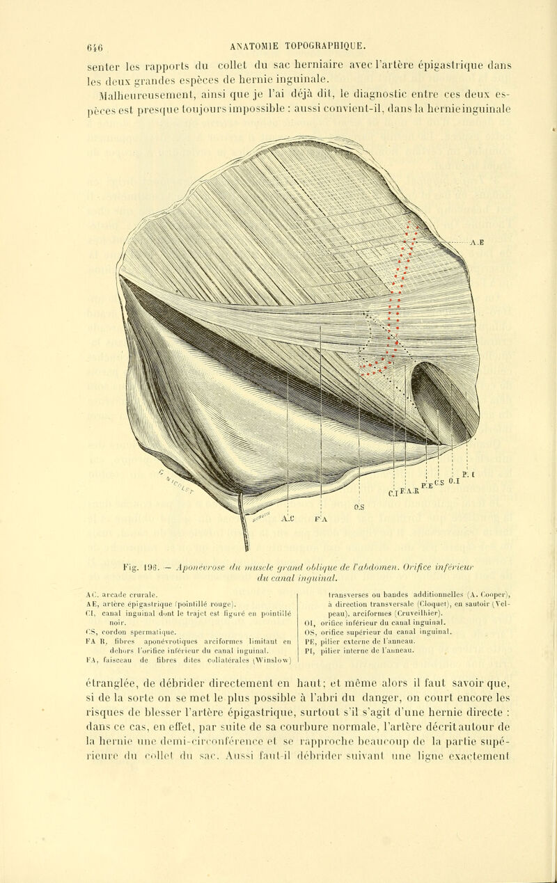 senter les rapports du collet du sac herniaire avec l'artère épigastrique dans les deux grandes espèces de hernie inguinale. Malheureusement, ainsi que je l'ai déjà dit, le diagnostic entre ces deux es- pèces est presque toujours impossible : aussi convient-il, dans la hernieinguinale es 0.1 Fig. 196. — Aponévrose du muscle grand oblique de Vabdomen. Orifice inférieur du canal inguinal. Al'., arcade crurale. AE, artère épigastrique (pointillé rouge). CI, canal inguinal dont le trajet est figuré en pointillé noir. CS, cordon spermatique. FA li, fibres aponévrotiques arciformes limitaut en dehors l'orifice inférieur du canal inguinal. FA, faisceau de fibres dites collatérales (Winslow) transverses ou bandes additionnelles (A. Cooper), à direction transversale (Cloquet), en sautoir (Yel- peau), arciformes (Cruveilbier). 01, orifice inférieur du caual inguinal. OS, orifice supérieur du canal inguinal. PE, pilier externe de l'anneau. PI, pilier interne de l'anneau. étranglée, de débrider directement en haut; et même alors il faut savoir que, si de la sorte on se met le plus possible à l'abri du danger, on court encore les risques de blesser l'artère épigastrique, surtout s'il s'agit d'une hernie directe : dans ce cas, en effet, par suite de sa courbure normale, l'artère décrit autour de la hernie une demi-circonférence et se rapproche beaucoup de la partie supé- rieure du colle! du sac. Aussi faut-il débrider suivant une ligue exactement