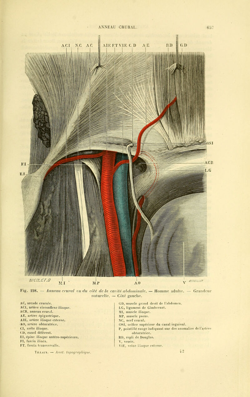 NICOLEf.a Fig. 198. —Anneau crural vu du côté delà cavité abdominale. — Homme adulto. — Grandeur naturelle. — Côté gauche. AC, arcade crurale. AC1, artère circonflexe iliaque. ACH, anneau crur.il. AE, artère épi gastrique. AIE, artère iliaque externe. ■AO, artère obturatrice. CI, crête iliaque. CD, canal déférent. El, épine iliaque antéro-supérieure. FI, fascia iliaca. FT, fascia transversalis. Tillavx. — Anal, topographique. GD, muscle grand droit de l'abdomen. LG, ligament de Gimbcrnat. MI, muscle iliaque. MP, muscle psoas. NC, nerf crural, OSI, orifice supérieur du canal inguinal. P, pointillé rouge indiquant une des anomalies de l'artère obturatrice. RD, repli de Douglas. V, vessie. VIE, veine iliaque externe. A3