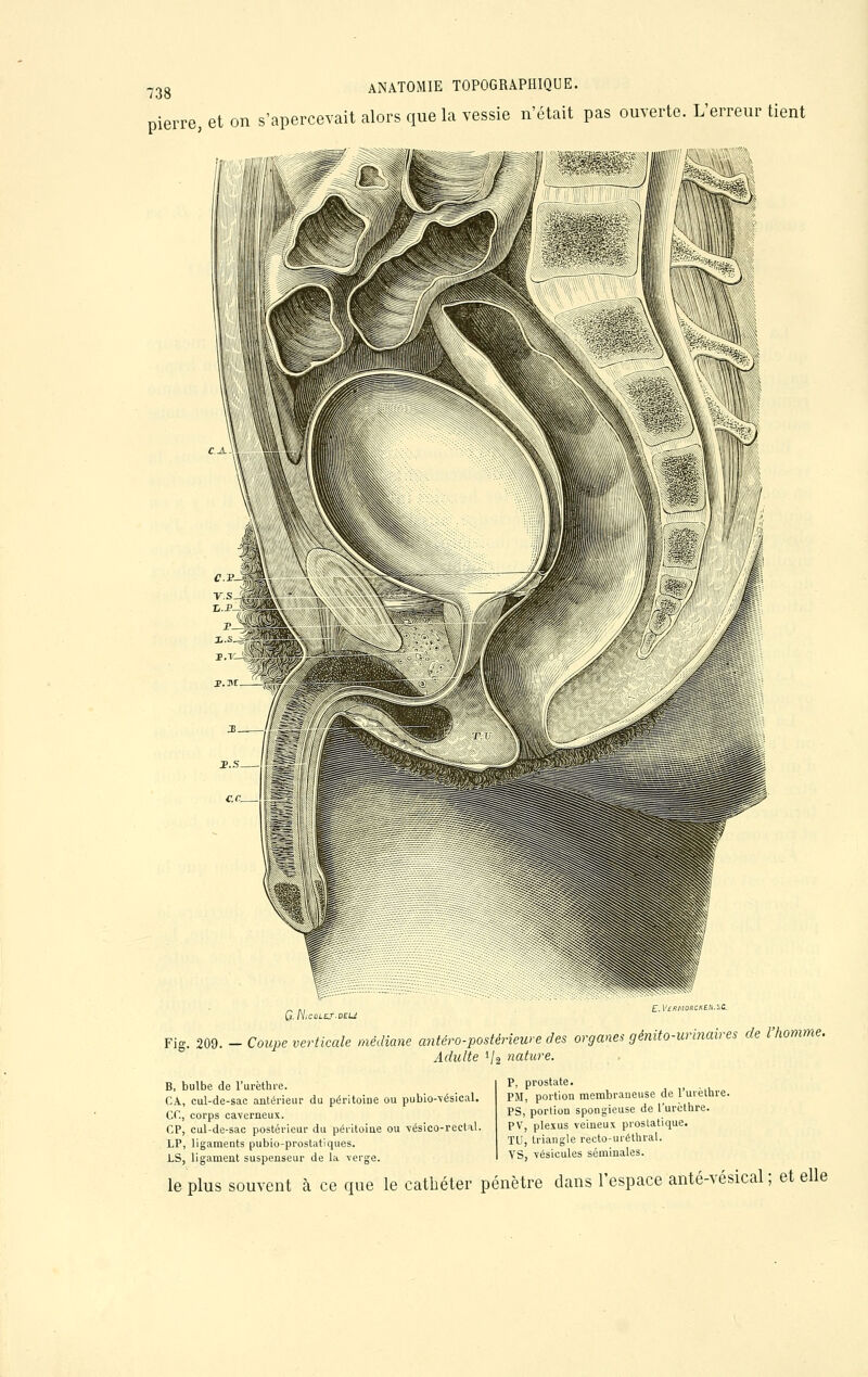 pierre, et on s'apercevait alors que la vessie n'était pas ouverte. L'erreur tient G.NiCOLEf-DELi E. |'f«AIO»C«Eft.St Fig. 209. - Coupe verticale médiane antéro-postériewe des organes génito-urinaires de l'homme. Adulte */a nature. B, bulbe de l'urèthre. CA., cul-de-sac antérieur du péritoine ou pubio-vésical. CC, corps caverneux. CP, cul-de-sac postérieur du péritoine ou vésico-rectal. LP, ligaments pubio-prostatiques. LS, ligament suspenseur de la verge. P, prostate. PII, portion membraneuse de l'urèthre. PS, portion spongieuse de l'urèthre. PV, plexus veineux prostatique. TU, triangle recto-uiéthral. VS, vésicules séminales. le plus souvent à ce que le cathéter pénètre clans l'espace anté-vésical ; et elle