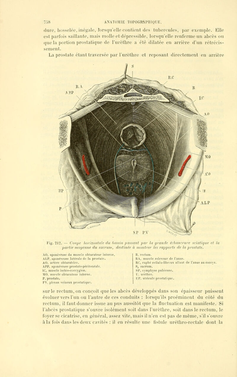 dure, bosselée, inégale, lorsqu'elle contient des tubercules, par exemple. Elle est parfois saillante, mais molle et dépressible, lorsqu'elle renferme un abcès ou que la portion prostatique de l'urèthre a été dilatée en arrière d'un rétrécis- sement. La prostate étant traversée par l'urèthre et reposant directement en arrière Fig. 212. — Coupe horizontale du bassin passant par la grande échancrure sciatique et la partie moyenne du sacrum, destinée à montrer les rapports de la prostate. AO, aponévrose du muscle obturateur interne. ALP, aponévrose latérale de la prostate. AO, artère obturatrice. APP, aponévrose prostato-péritonéale. 1C, muscle ischio-coccygien. MO, muscle obturateur interne. P, prostate. PY, plexus veineux prostatique. R, rectum. RA, muscle releveur de l'anus. RC, raphé cellulo-Gbrcux allant de l'anus au coccyx. S, sacrum. SP, symphyse pubienne. U, urètbre. DP, utricule prostatique. sur le rectum, on conçoit que les abcès développés dans son épaisseur puissent évoluer vers l'un ou l'autre de ces conduits : lorsqu'ils proéminent du côté du rectum, il faut donner issue au pus aussitôt que la fluctuation est manifeste. Si l'abcès prostatique s'ouvre isolément soit dans l'urèthre, soit dans le rectum, le foyer se cicatrise, en général, assez vite, mais il n'en est pas de même, s'il s'ouvre à la fois dans les deux cavités : il en résulte une fistule uréthro-rectale dont la