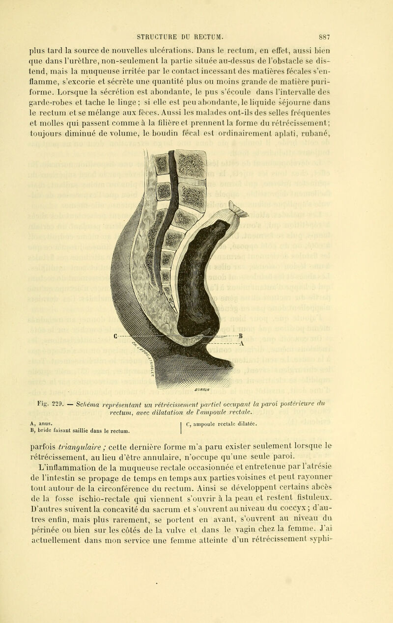 plus tard la source de nouvelles ulcérations. Dans le rectum, en effet, aussi bien que dans l'urèthre, non-seulement la partie située au-dessus de l'obstacle se dis- tend, mais la muqueuse irritée par le contact incessant des matières fécales s'en- flamme, s'excorie et sécrète une quantité plus ou moins grande de matière puri- forme. Lorsque la sécrétion est abondante, le pus s'écoule dans l'intervalle des garde-robes et tache le linge; si elle est peu abondante, le liquide séjourne dans le rectum et se mélange aux fèces. Aussi les malades ont-ils des selles fréquentes et molles qui passent comme à la filière et prennent la forme du rétrécissement; toujours diminué de volume, le boudin fécal est ordinairement aplati, rubané, Fig. 229. — Schéma représentant un rétrécissement partiel occupant la paroi postérieure du rectum, avec dilatation de l'ampoule rectale. A, anus. B, bride faisant saillie dans le rectum. C, ampoule rectale dilatée. parfois triangulaire ; cette dernière forme m'a paru exister seulement lorsque le rétrécissement, au lieu d'être annulaire, n'occupe qu'une seule paroi. L'inflammation de la muqueuse rectale occasionnée et entretenue par l'atrésie de l'intestin se propage de temps en temps aux parties voisines et peut rayonner tout autour de la circonférence du rectum. Ainsi se développent certains abcès de la fosse ischio-rectale qui viennent s'ouvrir à la peau et restent fistuleux. D'autres suivent la concavité du sacrum et s'ouvrent au niveau du coccyx; d'au- tres enfin, mais plus rarement, se portent en avant, s'ouvrent au niveau du. périnée ou bien sur les côtés de la vulve et dans le vagin chez la femme. J'ai actuellement dans mon service une femme atteinte d'un rétrécissement syphi-