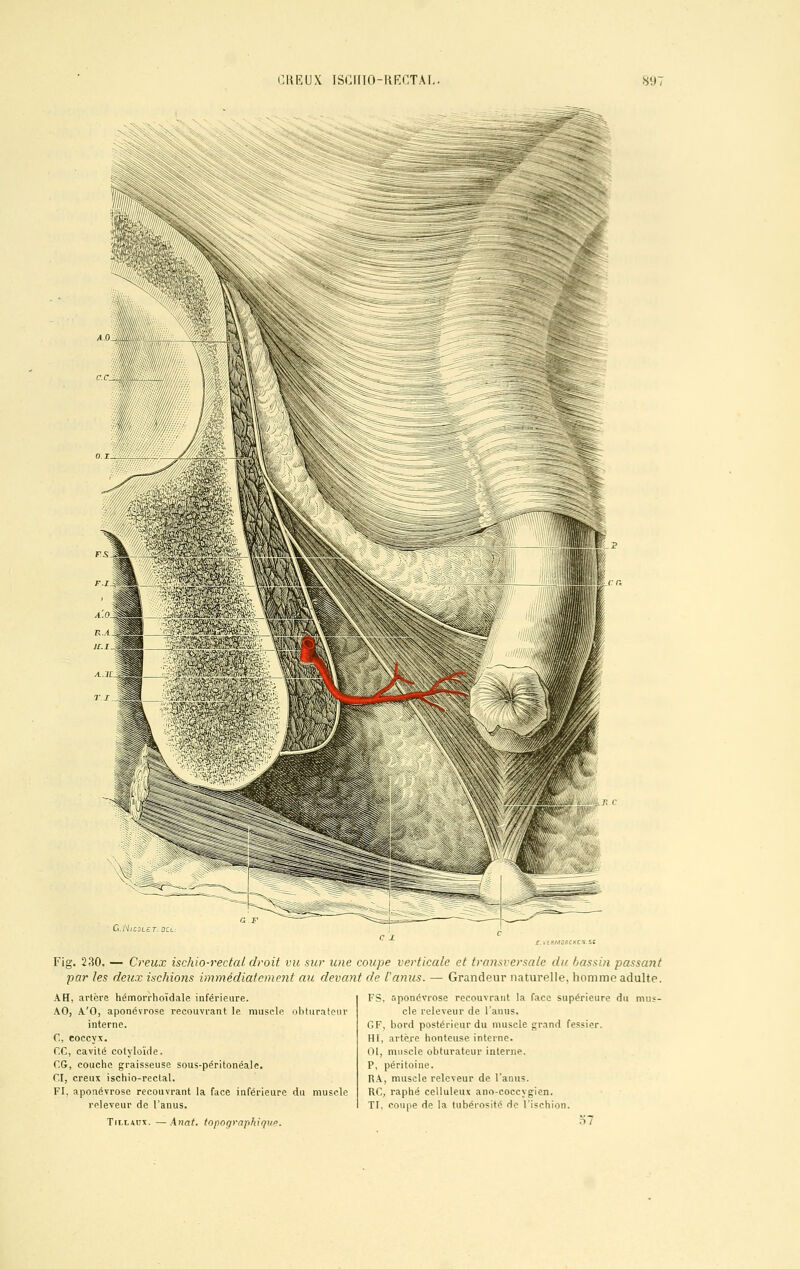 CHRUX ISCHIO-RECTAL 89 fflMJPCKE.V.SC Fig. 230. — Creux ischio-rectal droit vu sur une coupe verticale et transversale du bassin passant par les deux ischions immédiatement au devant de l'anus. — Grandeur naturelle, homme adulte. AH, artère hémorrhoïdale inférieure. AO, A'O, aponévrose recouvrant le muscle obturateur interne. C] coccyx. f.C, cavité cotyloïde. CG, couche graisseuse sous-péritonéale. CI, creux ischio-rectal. FI, aponévrose recouvrant la face inférieure du muscle releveur de l'anus. Tillâux. —Anat. topographique. FS. aponévrose recouvrant la face supérieure du mus- cle releveur de l'anus. GF, bord postérieur du muscle grand fessier. HT, artère honteuse interne. 01, muscle obturateur interne. P, péritoine. RA, muscle releveur de l'anus. RC, raphé celluleux ano-coceygien. TI. coupe de la tubérosité He l'ischion.