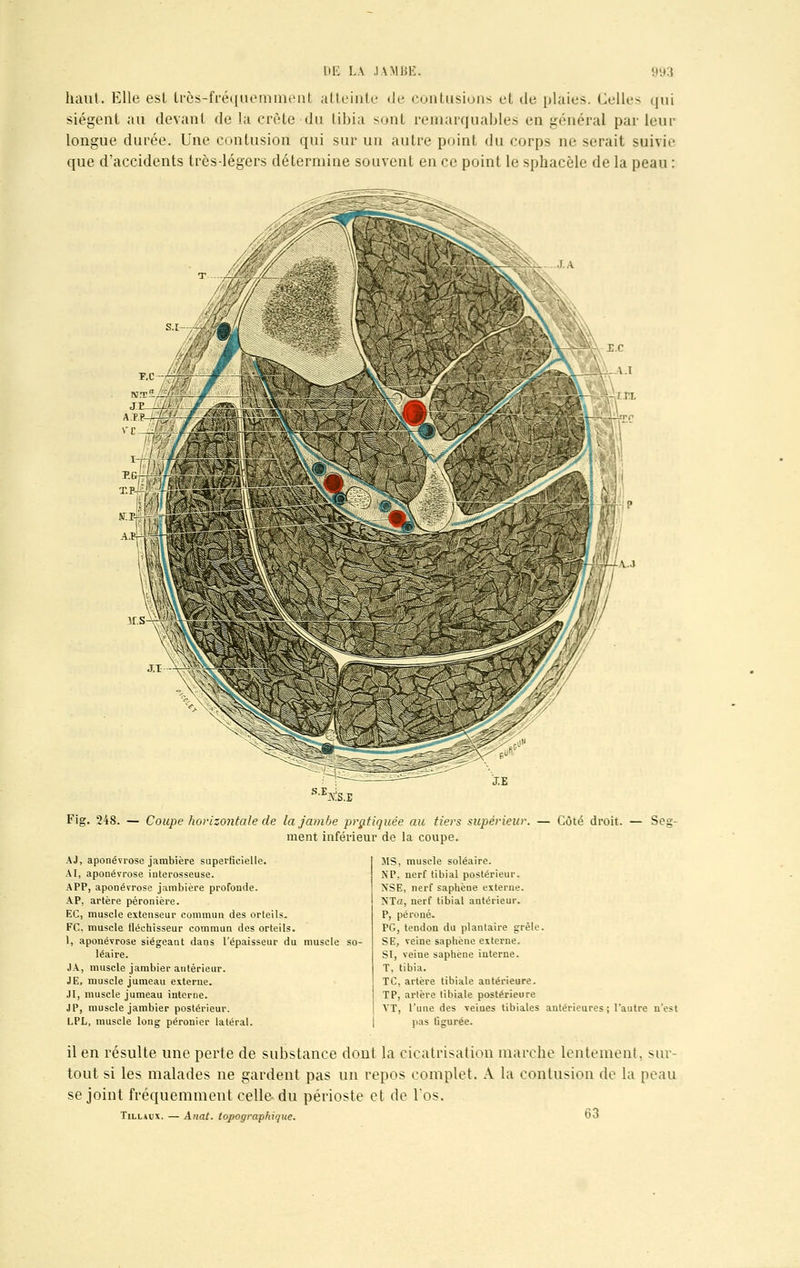 haut. Elle esl très-fréquemment atteinte de contusions et de plaies. Celles qui siègent au devant de la crête-du tibia sont remarquables en général parleur longue durée. Une contusion qui sur un autre point du corps ne serait suivie que d'accidents très-légers détermine souvent en ce point le sphacèle de la peau : . .I..V Fig. 248. — Coupe horizontale de la jambe pratiquée au tiers supérieur. — Côté droit. ment inférieur de la coupe. Ses- AJ, aponévrose jambière superficielle. AI, aponévrose interosseuse. APP, aponévrose jambière profonde. AP, artère péronière. EC, muscle extenseur commun des orteils. FC. muscle fléchisseur commun des orteils. 1, aponévrose siégeant dans l'épaisseur du muscle so- léaire. JA, muscle jambier antérieur. JE, muscle jumeau externe. JI, muscle jumeau interne. JP, muscle jambier postérieur. LPL, muscle long péronier latéral. MS, muscle soléaire. NP. nerf tibial postérieur. NSE, nerf saphène externe. NTa, nerf tibial antérieur. P, péroné. PG, tendon du plantaire grêle. SE, veine saphène externe. SI, veine saphène interne. T, tibia. TC, artère tibiale antérieure. TP, artère tibiale postérieure YT, l'une des veines tibiales antérieures ; l'autre n'est pas figurée. il en résulte une perte de substance dont la cicatrisation marche lentement, sur- tout si les malades ne gardent pas un repos complet. A la contusion de la peau se joint fréquemment celle du périoste et de l'os. Tillu'x. — Anat. topographique. Oo