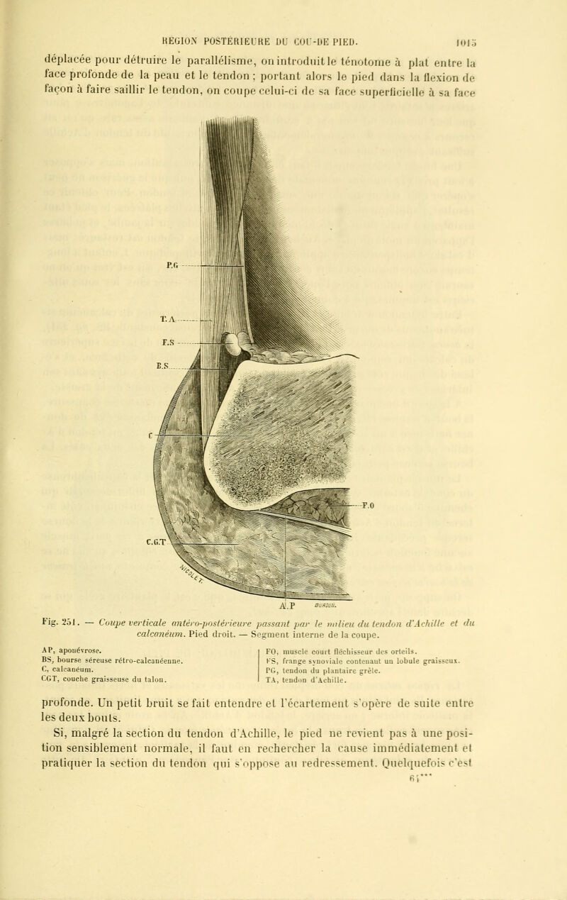 MHS déplacée pour détruire le parallélisme, on introduit le ténotome à plat entre la face profonde de la peau et le tendon ; portant alors le pied dans la flexion de façon à faire saillir le tendon, on coupe celui-ci de sa face superficielle à sa face -F.O ALP Fig. 251. — Coupe verticale antéro-postérieure passant par le milieu du tendon d'Achille et du calcanéum. Pied droit. — Segment interne de la coupe. AP, apouévrose. BS, bourse séreuse rétro-calcanéenne. C, caleanéum. CGT, couche graisseuse du talou. FO, muscle court fléchisseur des orteils. l'S, frange synoviale contenant un lobule graisseux. PG, tendon du plantaire grêle. TA, tendon d'Achille. profonde. Un petit bruit se fait entendre el l'écartement s'opère de suite entre les deux bouts. Si, malgré la section du tendon d'Achille, le pied ne revient pas à une posi- tion sensiblement normale, il faut en rechercher la cause immédiatement et pratiquer la section du tendon qui s'oppose au redressement. Quelquefois c'est 61**'