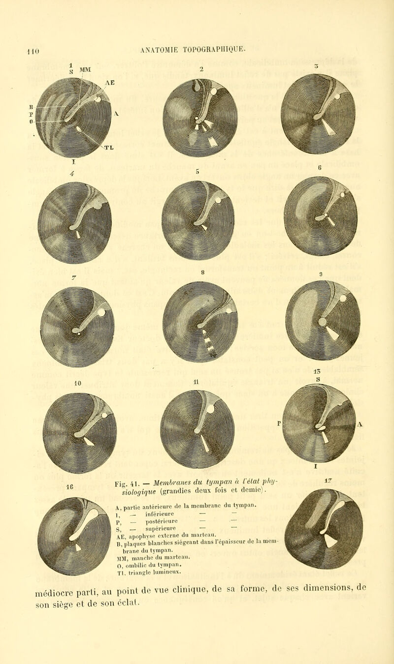 dlO 2 10 Fig. 41. — Membranes du tympan à l'élat phy- dologique (grandies deux fois et demie). \. partie antérieure de la membrane du tympan. I. — inférieure — ~ W — postérieure — — j,^ — supérieure — AE, apophyse externe du marteau. B, plaques blanches siégeant dans l'épaisseur de la mem brane du tympan. IIM, manche du marteau. 0, ombilic du tympan. Tl, triangle lumineux. médiocre parti, au point do vue clinique, de sa forme, de ses dimensions, de son sièsre et de son éclat.