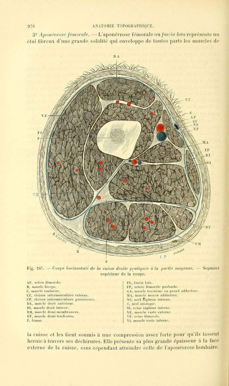 o° Aponévrose fémorale. — L'aponévrose fémorale owfascia lata représente un étui fibreux d'une grande solidité qui enveloppe de toutes parts les muscles de D.A Fig. 247. — Coupe horizontale de la cuisse droite pratiquée à la partie moyeniie. supérieur de la coupe. — Sesiment A F, artère fémorale. B, muscle biceps. C, muscle couturier. GE, cloison intermusculaire externe. CPj cloison intermusculaire postérieiu'e. D.\, muscle droit antérieur. DI, muscle droit interne. D.y, muscle dcnii-membraneux. BT, muscle demi-tendi.ieux. F, fémur. FL, fascia lata. FP, artère fémorale profonde. t;A, muscle troisième ou grand adducteur. MA, muscle moyen adducteur. NS, nerf ^^phèue interne. S, nerf seiatique. SI, veine sapliène interne. \E, muscle vaste externe. VF, veine fémorale. VI, muscle vaste interne. la cuisse et les tient soumis à une compression assez forte pour qu'ils lassent hernie à travers ses déchirures. Elle présente sa plus grande épaisseur à la face externe de la cuisse, sans cependant atteindre celle de l'aponévrose lombaire.