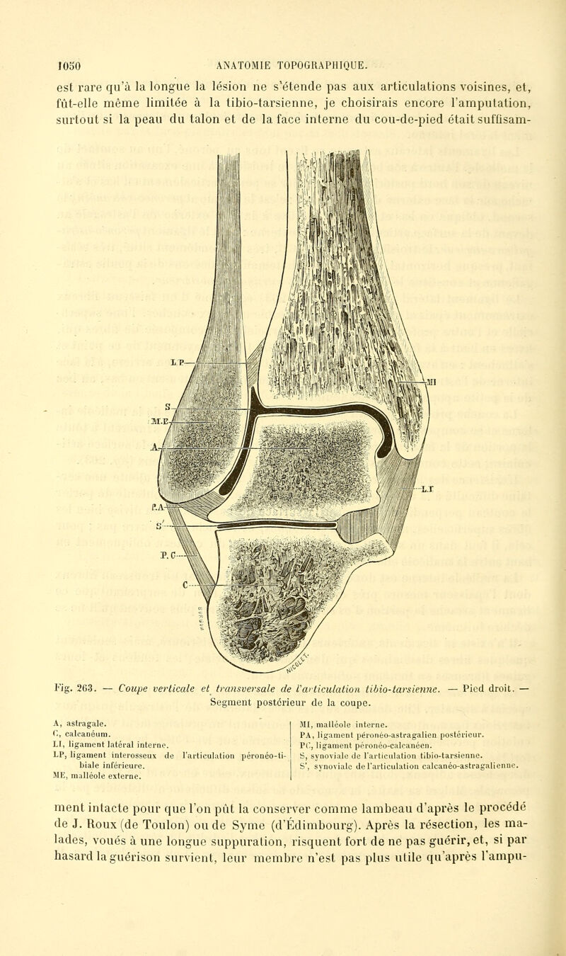 est rare qu'à la longue la lésion ne s'étende pas aux articulations voisines, et, fût-elle même limitée à la tibio-tarsienne, je choisirais encore l'amputation, surtout si la peau du talon et de la face interne du cou-dc-pied était suftisam- Fig. 2G3. — Coupe verticale et transversale de Varticulation iibio-tarsienne. — Pied droit. Segment postérieur de la coupe. A, astragale. C, calcanéum. LI, ligament latéral interne. LP, ligament interosseux de l'articulation péronéo-ti- biale inférieure. ME, malléole externe. MI, malléole interne. PA, ligament péronéo-asti-agalien postérieur. PO, ligament pcronéo-calcanéen. S, synoviale de l'articulation tibio-tarsienne. S', synoviale de l'articulation calcanéo-astragaliennc. ment intacte pour que l'on pût la conserver comme lambeau d'après le procédé de J. Roux (de Toulon) ou de Syme (d'Edimbourg). Après la résection, les ma- lades, voués à une longue suppuration, risquent fort de ne pas guérir, et, si par hasard la guérison survient, leur membre n'est pas plus utile qu'après l'ampu-