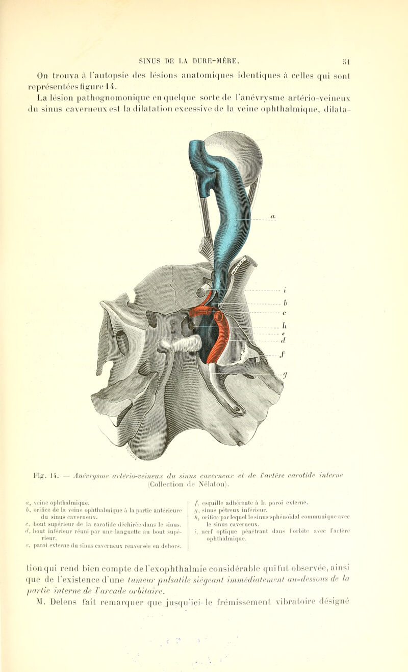 On trouva à l'aulopsie des lésions aiialoiiii(|ii('s i(l('ii(i(ni('s à celles ((iii soul représentées lii;in*e 1 i. La lésion pathoi'nomoniqne en (|iiel(|iie sorte de l'anévi'ysme ai'téi'io-veineiix du sinus caveruetix est la il i la lai ion excessive do la, veiue i»phl haluiique, dilala- Fig. 14. — Ancvrysme artério-veineur du shius caverneux el de l'arlère carotide interne (Collortion ilr Nélaton). a. v(?ine ophthalmique. b. orifice de la veine ophthalmiqiie à la partie antérieupo du sinus caverneux. c. bout supéi-ieur de la carotide déchirée dans le sinus. '', bout inférieur réuni par une languette au l)out supé- rieur. ''. paroi externe du sinus caverneux renversée en dehors. /■, esquille adhérente à la paroi externe. (/, sinus pétreux inférieni'. /(, orifice parlequel lesinus spliéuoïdal coninumique avec le sinus caverneux. /, nerf optique pénétrant dans l'orbite avec l'artère ophthalmique. tionqui rend bien compte deTexoplithalinie considérable qui l'ut ol)servée, ainsi que de l'existence d'une tumeur pahatiJe sii''grant immédàitcnn'iil an-dpssom de la partie interne de Varcade orbitaire. M. Delens fait remarquer qne jusqu'ici-le frémissement vibratoire désigné