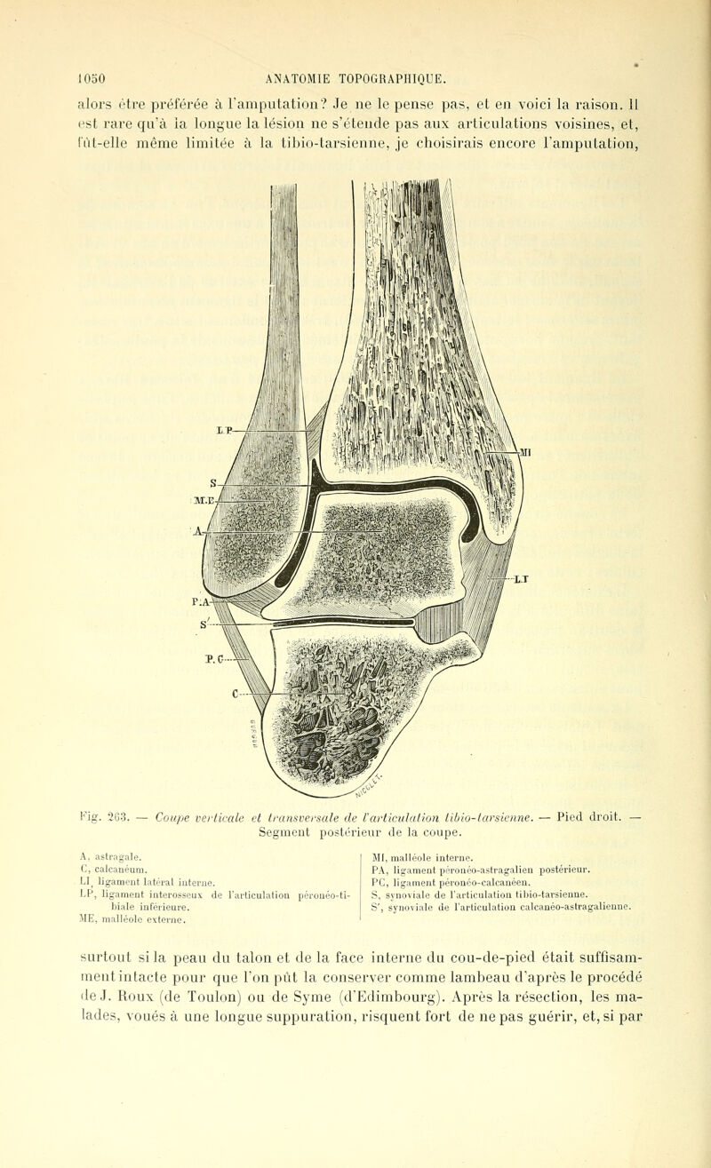 alors être préférée à l'amputation? Je ne le pense pas, et en voici la raison, il est rare qu'à la longue la lésion ne s'étende pas aux articulations voisines, et, l'ùt-elle même limitée à la tibio-tarsienne, je choisirais encore l'amputation, V'ig. 2G3. — Coupe vei-licale et transversale de rarticulation tibio-tarsicnne. — Pied droit. Segmeut postérieur de la coupe. A, astragale. C, calcanéum. LI^ ligament latéral iutenie. I.P, ligament interosseuv de l'articulation péronéo-ti- biale inférieure. ME, malléole externe. MI, malléole interne. PA, ligament péronéo-astragalien postérieur. PC, ligament péronéo-calcanéen. S, synoviale de l'articulation tibio-tarsienne. S', synoviale de l'articulation calcauéo-astragalienne. surtout si la peau du talon et de la face interne du cou-de-pied était suffisam- ment intacte pour que l'on put la conserver comme lambeau d'après le procédé de J. Roux (de Toulon) ou de Syme (d'Edimbourg). Après la résection, les ma- lades, voués à une longue suppuration, risquent fort de ne pas guérir, et, si par