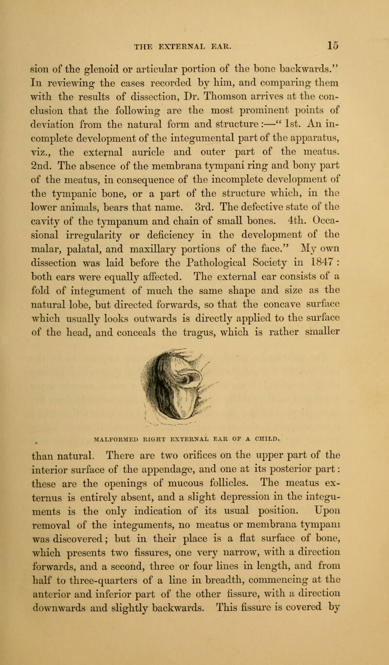 sion of the glenoid or articular portion of the bone backwards. In reviewing the cases recorded by him, and comparing them with the results of dissection, Dr. Thomson arrives at the con- clusion that the following are the most prominent points of deviation from the natural form and structure :— 1st. An in- complete development of the integumental part of the apparatus, viz., the external auricle and outer part of the meatus. 2nd. The absence of the membrana tympani ring and bony part of the meatus, in consequence of the incomplete development of the tympanic bone, or a part of the structure which, in the lower animals, bears that name. 3rd. The defective state of the cavity of the tympanum and chain of small bones. 4th. Occa- sional irregularity or deficiency in the development of the malar, palatal, and maxillary portions of the face. My own dissection was laid before the Pathological Society in 1847 : both ears were equally affected. The external ear consists of a fold of integument of much the same shape and size as the natural lobe, but directed forwards, so that the concave surface which usually looks outwards is directly applied to the surface of the head, and conceals the tragus, which is rather smaller MALFORMED RIGHT EXTERNAL EAR OF A CHILD. than natural. There are two orifices on the upper part of the interior surface of the appendage, and one at its posterior part: these are the openings of mucous follicles. The meatus ex- ternus is entirely absent, and a slight depression in the integu- ments is the only indication of its usual position. Upon removal of the integuments, no meatus or membrana tympani was discovered; but in their place is a flat surface of bone, which presents two fissures, one very narrow, with a direction forwards, and a second, three or four lines in length, and from half to three-quarters of a line in breadth, commencing at the anterior and inferior part of the other fissure, with a direction downwards and slightly backwards. This fissure is covered by