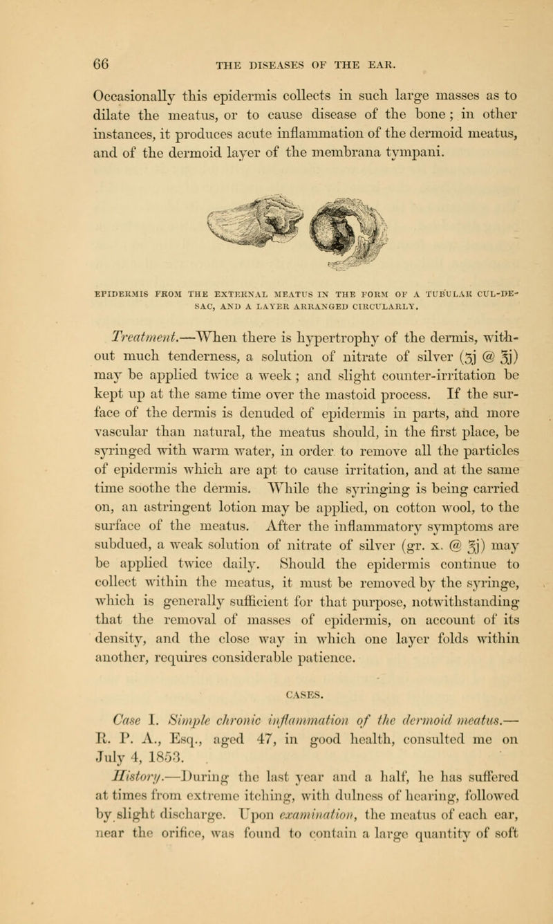 Occasionally this epidermis collects in such large masses as to dilate the meatus, or to cause disease of the bone ; in other instances, it produces acute inflammation of the dermoid meatus, and of the dermoid layer of the membrana tympani. EPIDERMIS PROM THE EXTERNAL MEATUS IN THE FORM OF A TUBULAR CUL-DE- SAC, AND A LAYER ARRANGED CIRCULARLY. Treatment.—When there is hypertrophy of the dermis, with- out much tenderness, a solution of nitrate of silver (3J @ 3j) may be applied twice a week ; and slight counter-irritation be kept up at the same time over the mastoid process. If the sur- face of the dermis is denuded of epidermis in parts, and more vascular than natural, the meatus should, in the first place, be syringed with warm water, in order to remove all the particles of epidermis which are apt to cause irritation, and at the same time soothe the dermis. While the syringing is being carried on, an astringent lotion may be applied, on cotton wool, to the surface of the meatus. After the inflammatory symptoms are subdued, a weak solution of nitrate of silver (gr. x. @ 3j) may be applied twice daily. Should the epidermis continue to collect within the meatus, it must be removed by the syringe, which is generally sufficient for that purpose, notwithstanding that the removal of masses of epidermis, on account of its density, and the close way in which one layer folds within another, requires considerable patience. CASES. Case 1. Simple chronic inflammation of the dermoid meatus.— R. 1\ A., Esq., aged 47, in good health, consulted me on July 4, 1853. History.—During the last year and a half, he has suffered ;ii times from extreme itching, with dulness of hearing, followed by slight discharge. Upon examination, the meatus of each ear, near the orifice, was found to contain a large quantity of soft