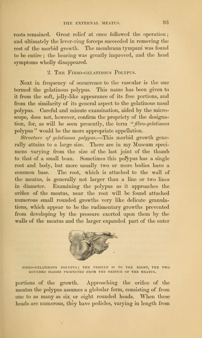 roots remained. Great relief at once followed the operation ; and ultimately the lever-ring forceps succeeded in removing the rest of the morbid growth. The membrana tympani was found to be entire ; the hearing was greatly improved, and the head symptoms wholly disappeared. 2. The Fibro-gelatinous Polypus. Next in frequency of occurrence to the vascular is the one termed the gelatinous polypus. This name has been given to it from the soft, jelly-like appearance of its free portions, and from the similarity of its general aspect to the gelatinous nasal polypus. Careful and minute examination, aided by the micro- scope, does not, however, confirm the propriety of the designa- tion, for, as will be seen presently, the term fibro-gelatinous polypus  would be the more appropriate appellation. Structure of gelatinous polypus.—This morbid growth gene- rally attains to a large size. There are in my Museum speci- mens varying from the size of the last joint of the thumb to that of a small bean. Sometimes this polypus has a single root and body, but more usually two or more bodies have a common base. The root, which is attached to the wall of the meatus, is generally not larger than a line or two lines in diameter. Examining the polypus as it approaches the orifice of the meatus, near the root will be found attached numerous small rounded growths very like delicate granula- tions, which appear to be the rudimentary growths prevented from developing by the pressure exerted upon them by the walls of the meatus and the larger expanded part of the outer FIBRO-GELATINOUS POLYPUS ; THE PEDICLE IS TO THE RIGHT, THE TWO ROUNDED MASSES PROJECTED FROM THE ORIFICE OF THE MEATUS. portions of the growth. Approaching the orifice of the meatus the polypus assumes a globular form, consisting of from one to as many as six or eight rounded heads. When these heads are numerous, they have pedicles, varying in length from