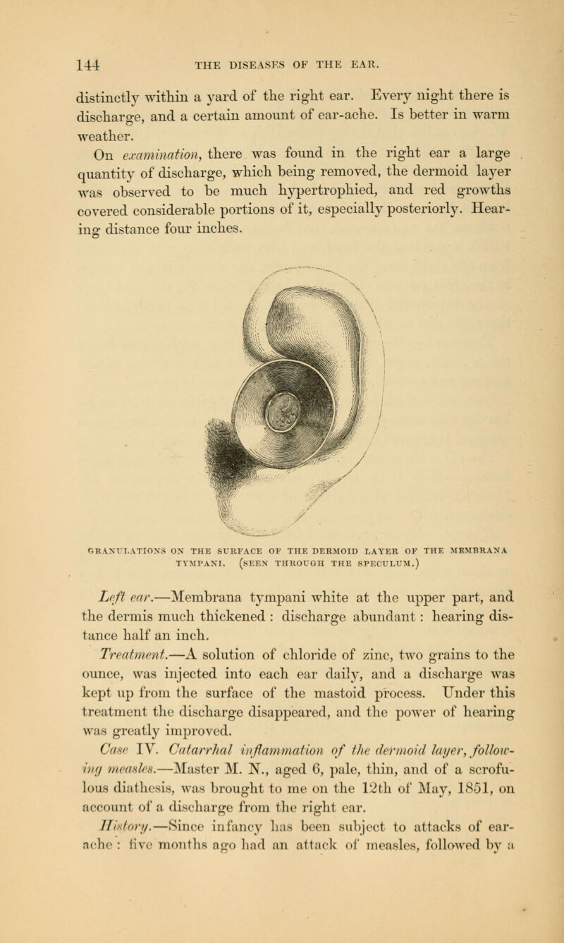 distinctly within a yard of the right ear. Every night there is discharge, and a certain amount of ear-ache. Is better in warm weather. On examination, there was found in the right ear a large quantity of discharge, which being removed, the dermoid layer was observed to be much hypertrophied, and red growths covered considerable portions of it, especially posteriorly. Hear- ing distance four inches. GRANULATIONS ON THE SURFACE OF THE DERMOID LAYER OF THE MBMBRANA TYMPANI. (SEEN THROUGH THE SPECULUM.) Left car.—Membrana tympani white at the upper part, and the dermis much thickened : discharge abundant hearing dis- tance half an inch. Treatment.—A solution of chloride of zinc, two grains to the ounce, was injected into each ear daily, and a discharge was kept up from the surface of the mastoid process. Under this treatment the discharge disappeared, and the power of hearing was greatly improved. Case IV. Catarrhal inflammation of the dermoid layer, follow- ing measles.—Master M. N., aged 6, pale, thin, and of a scrofu- lous diathesis, was brought to me on the 12th of May, 1851, on account of a discharge from the right ear. History.—Since infancy lias been subject to attacks of ear- ache : five months ago had an attack <>f measles, followed by a