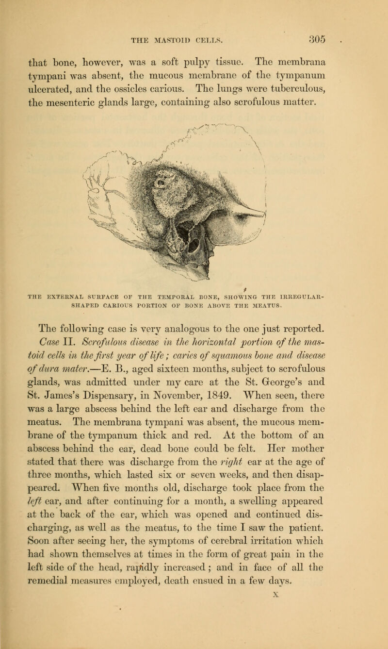 that bone, however, was a soft pulpy tissue. The membrana tympani was absent, the mucous membrane of the tympanum ulcerated, and the ossicles carious. The lungs were tuberculous, the mesenteric glands large, containing also scrofulous matter. THE EXTERNAL SURFACE OF THE TEMPORAL BONE, SHOWING THE IRREGULAR- SHAPED CARIOUS PORTION OF BONE ABOVE THE MEATUS, The following case is very analogous to the one just reported. Case II. Scrofulous disease in the horizontal portion of the mas- toid cells in the first year of life; caries of squamous bone and disease of dura mater.—E. B., aged sixteen months, subject to scrofulous glands, was admitted under my care at the St. George's and St. James's Dispensary, in November, 1849. When seen, there was a large abscess behind the left ear and discharge from the meatus. The membrana tympani was absent, the mucous mem- brane of the tympanum thick and red. At the bottom of an abscess behind the ear, dead bone could be felt. Her mother stated that there was discharge from the right ear at the age of three months, which lasted six or seven weeks, and. then disap- peared. When five months old, discharge took place from the left ear, and after continuing for a month, a swelling appeared at the back of the ear, which was opened and continued dis- charging, as well as the meatus, to the time I saw the patient. Soon after seeing her, the symptoms of cerebral irritation which had shown themselves at times in the form of great pain in the left side of the head, rapidly increased; and in face of all the remedial measures employed, death ensued in a few days. x