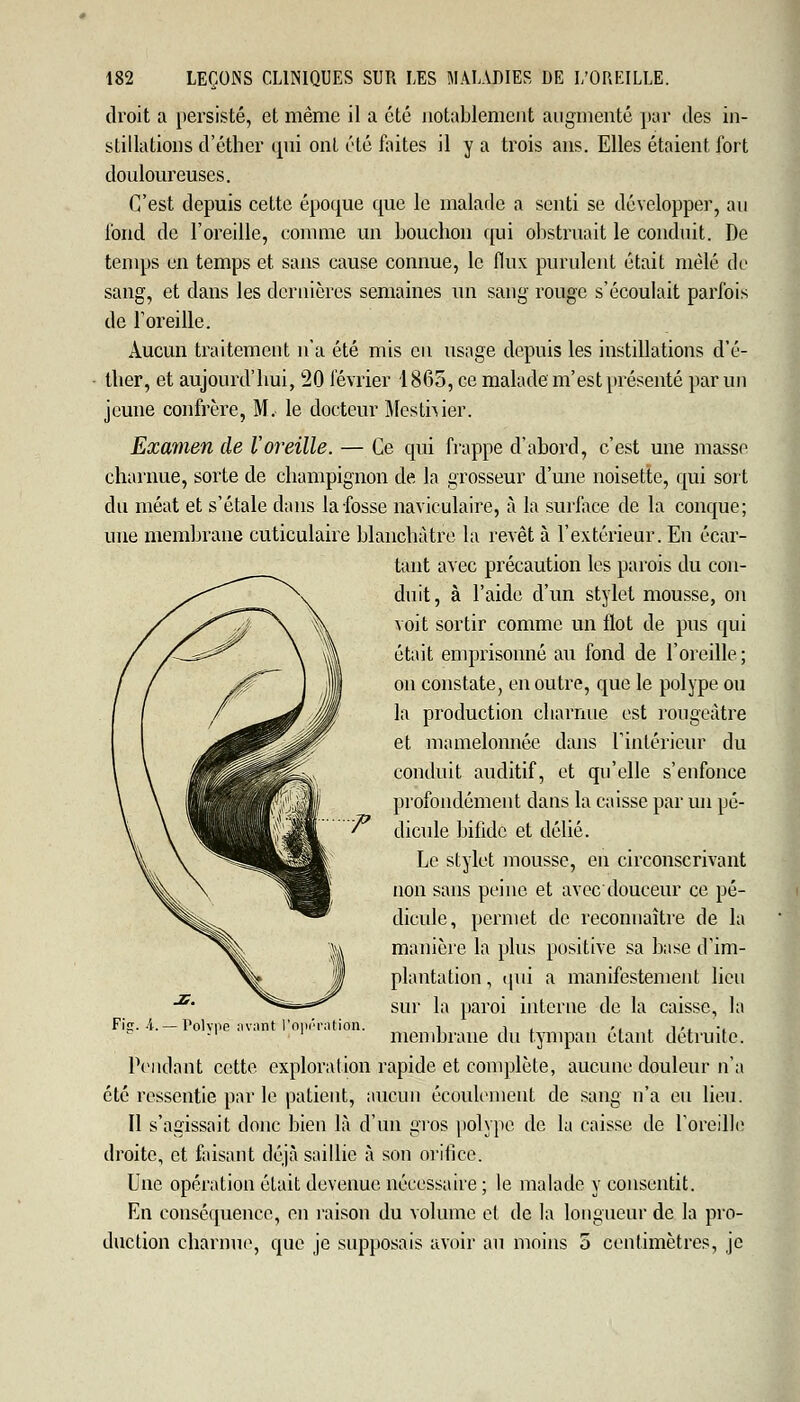 droit a persisté, et même il a été notablement augmenté par des in- stillations d'éther qui ont été faites il y a trois ans. Elles étaient fort douloureuses. C'est depuis cette époque que le malade a senti se développer, au fond de l'oreille, comme un bouchon qui obstruait le conduit. De temps en temps et sans cause connue, le flux purulent était mêlé de sang, et dans les dernières semaines un sang rouge s'écoulait parfois de l'oreille. Aucun traitement n'a été mis en usage depuis les instillations d'é- ther, et aujourd'hui, 20 février 1865, ce malade m'est présenté par un jeune confrère, M, le docteur Mestnier. Examen de l'oreille. — Ce qui frappe d'abord, c'est une masse charnue, sorte de champignon de la grosseur d'une noisette, qui sort du méat et s'étale dans la fosse naviculaire, à la surface de la conque; une membrane cuticulaire blanchâtre la revêt à l'extérieur. En écar- tant avec précaution les parois du con- duit, à l'aide d'un stylet mousse, on voit sortir comme un flot de pus qui était emprisonné au fond de l'oreille ; on constate, en outre, que le polype ou la production charnue est rougeàtre et mamelonnée dans l'intérieur du conduit auditif, et qu'elle s'enfonce profondément dans la caisse par un pé- dicule bifide et délié. Le stylet mousse, en circonscrivant non sans peine et avec douceur ce pé- dicule, permet de reconnaître de la manière la plus positive sa base d'im- plantation , qui a manifestement lieu sur la paroi interne de la caisse, la membrane du tympan étant détruite. Pendant cette exploration rapide et complète, aucune douleur n'a été ressentie par le patient, aucun écoulement de sang n'a eu lieu. Il s'agissait donc bien là d'un gros polype de la caisse de l'oreille droite, et faisant déjà saillie à son orifice. Une opération était devenue nécessaire ; le malade y consentit. En conséquence, en raison du volume et de la longueur de la pro- duction charnue, que je supposais avoir au moins 5 centimètres, je Fig. A.— Polype avant l'opération.