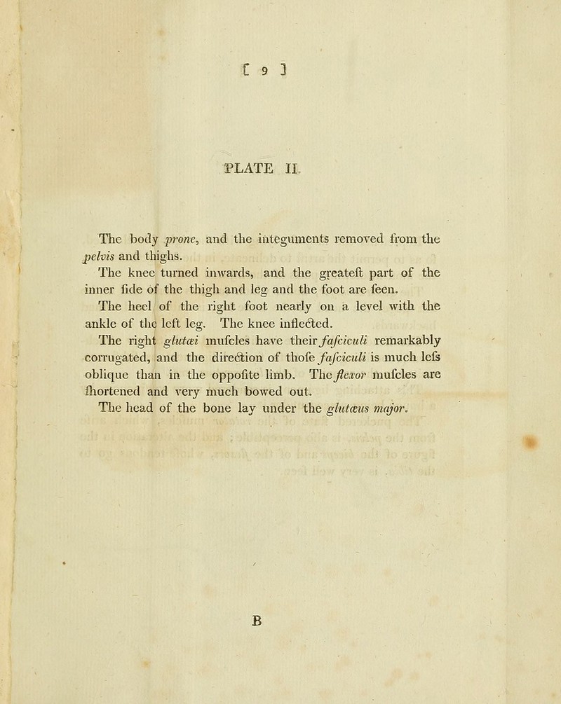 PLATE II. The body prone, and the integuments removed from the pelvis and thighs. The knee turned inwards, and the greateft part of the inner fide of the thigh and leg and the foot are feen. The heel of the right foot nearly on a level with the ankle of the left leg. The knee inflected. The right ghitcei mufcles have their fafciculi remarkably corrugated, and the dire6lion of tho{e fafciculi is much lefs oblique than in the oppofite limb. Thefexor mufcles are fhortened and very much bowed out. The head of the bone lay under the glutmis major.
