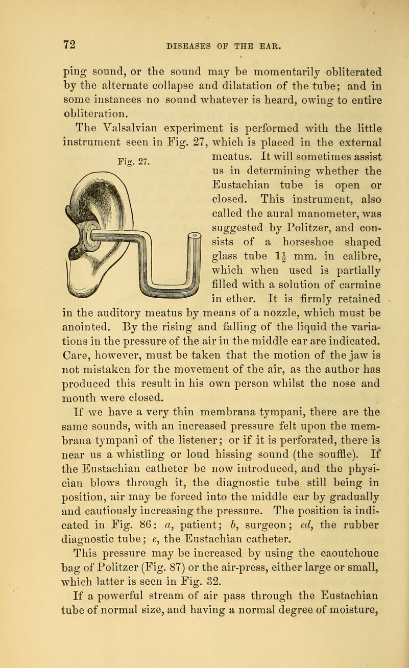 Fig. 27. ping sound, or the sound may be momentarily obliterated by the alternate collapse and dilatation of the tube; and in some instances no sound whatever is heard, owing to entire obliteration. The Valsalvian experiment is performed with the little instrument seen in Fig. 27, which is placed in the external meatus. It will sometimes assist us in determining whether the Eustachian tube is open or closed. This instrument, also called the aural manometer, was suggested by Politzer, and con- sists of a horseshoe shaped glass tube 1J mm. in calibre, which when used is partially filled with a solution of carmine in ether. It is firmly retained in the auditory meatus by means of a nozzle, which must be anointed. By the rising and falling of the liquid the varia- tions in the pressure of the air in the middle ear are indicated. Care, however, must be taken that the motion of the jaw is not mistaken for the movement of the air, as the author has produced this result in his own person whilst the nose and mouth were closed. If we have a very thin membrana tympani, there are the same sounds, with an increased pressure felt upon the mem- brana tympani of the listener; or if it is perforated, there is near us a whistling or loud hissing sound (the souffle). If the Eustachian catheter be now introduced, and the physi- cian blows through it, the diagnostic tube still being in position, air may be forced into the middle ear by gradually and cautiously increasing the pressure. The position is indi- cated in Fig. 86: a, patient; b, surgeon; ed, the rubber diagnostic tube; e, the Eustachian catheter. This pressure may be increased by using the caoutchouc bag of Politzer (Fig. 87) or the air-press, either large or small, which latter is seen in Fig. 32. If a powerful stream of air pass through the Eustachian tube of normal size, and having a normal degree of moisture,