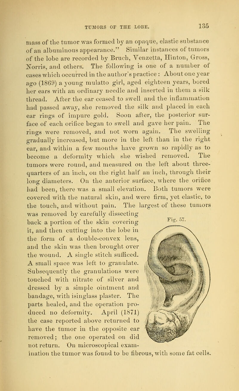 TUMORS OF THE LOBE. mass of the tumor was formed by an opaque, elastic substance of an albuminous appearance. Similar instances of tumors of the lobe are recorded by Brucb, Venzetta, Hinton, Gross, Morris, and others. The following is one of a number of cases which occurred in the author's practice : About one year ago (1869) a young mulatto girl, aged eighteen years, bored her ears with an ordinary needle and inserted in them a silk thread. After the ear ceased to swell and the inflammation had passed away, she removed the silk and placed iu each ear rings of impure gold. Soon after, the posterior sur- face of each orifice began to swell and gave her pain. The rings were removed, and not worn again. The swelling gradually increased, but more in the left than in the right ear, and within a few months have grown so rapidly as to become a deformity which she wished removed. The tumors were round, and measured on the left about three- quarters of an inch, on the right half an inch, through their long diameters. On the anterior surface, where the orifice had been, there was a small elevation. Both tumors were covered with the natural skin, and were firm, yet elastic, to the touch, and without pain. The largest of these tumors was removed by carefull}T dissecting back a portion of the skin covering it, and then cutting into the lobe in the form of a double-convex lens, and the skin was then brought over the wound. A single stitch sufficed. A small space was left to granulate. Subsequently the granulations were touched with nitrate of silver and dressed by a simple ointment and bandage, with isinglass plaster. The parts healed, and the operation pro- duced no deformity. April (1871) the case reported above returned to have the tumor in the opposite ear removed; the one operated on did not return. On microscopical exam- ination the tumor was found to be fibrous, with some fat cells. Fisr. 57.
