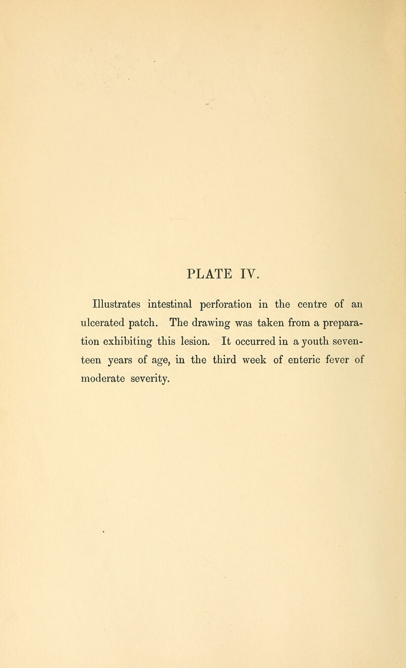 Illustrates intestinal perforation in the centre of an ulcerated patch. The drawing was taken from a prepara- tion exhibiting this lesion. It occurred in a youth seven- teen years of age, in the third week of enteric fever of moderate severity.