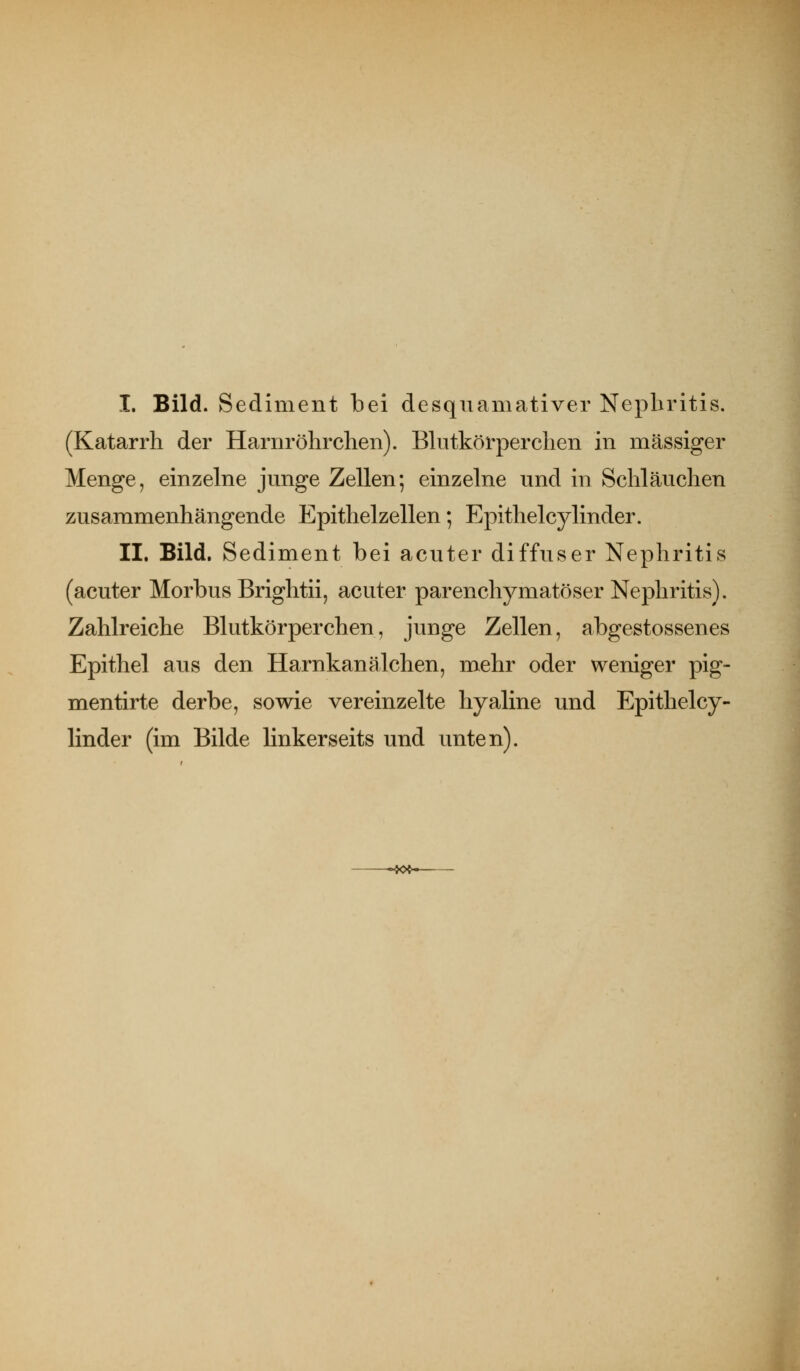 I. Bild. Sediment bei desquamativer Nephritis. (Katarrh der Harnröhrchen). Bhitkörperchen in massiger Menge, einzelne jmige Zellen; einzelne und in Schläuchen zusammenhängende Epithelzellen; Epithelcylinder. II. Bild. Sediment bei acuter diffuser Nephritis (acuter Morbus Brightii, acuter parenchymatöser Nephritis). Zahlreiche Blutkörperchen, junge Zellen, abgestossenes Epithel aus den Harnkanälchen, mehr oder weniger pig- mentirte derbe, sowie vereinzelte hyaline und Epithelcy- linder (im Bilde linkerseits und unten). \