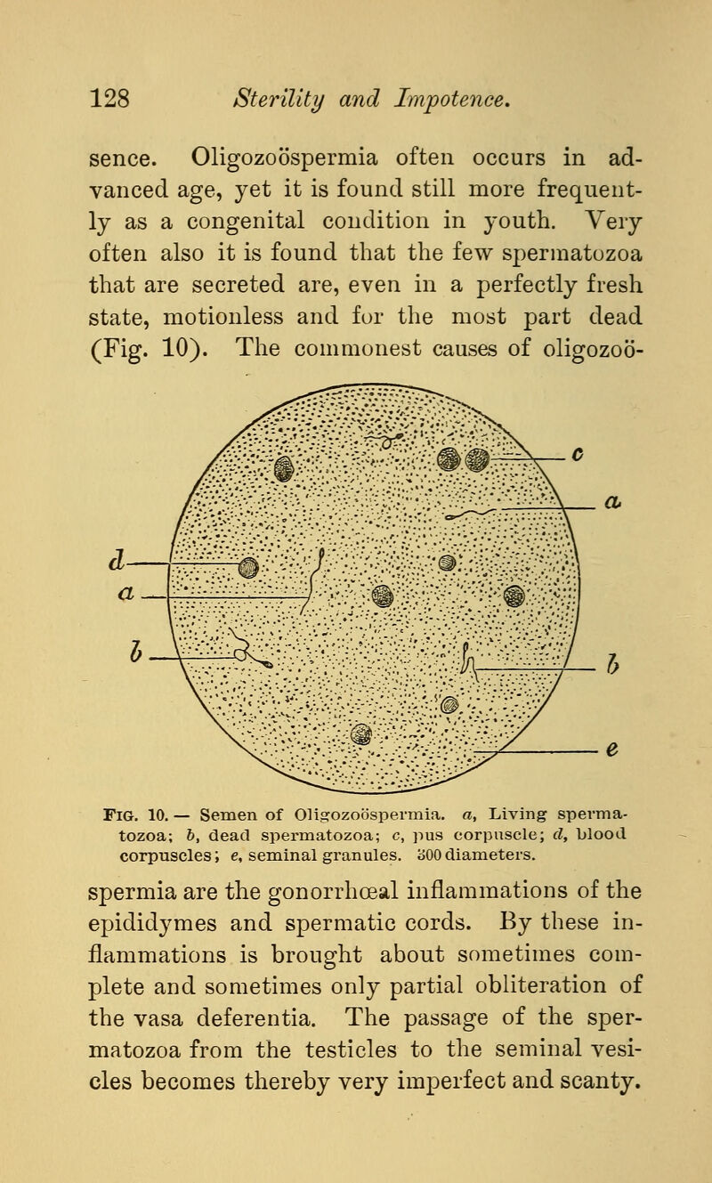 sence. Oligozoöspermia often occurs in ad- vanced age, yet it is found still more frequent- ly as a congenital condition in youth. Very often also it is found that the few spermatozoa that are secreted are, even in a perfectly fresh state, motionless and for the most part dead (Fig. 10). The commonest causes of oligozoö- FiG. 10. — Semen of Oligozoöspermia. a, Living sperma- tozoa; 6, dead spermatozoa; c, pus corpuscle; d, blood corpuscles; e, seminal granules. 300diameters. spermia are the gonorrheal inflammations of the epididymes and spermatic cords. By these in- flammations is brought about sometimes com- plete and sometimes only partial obliteration of the vasa deferentia. The passage of the sper- matozoa from the testicles to the seminal vesi- cles becomes thereby very imperfect and scanty.