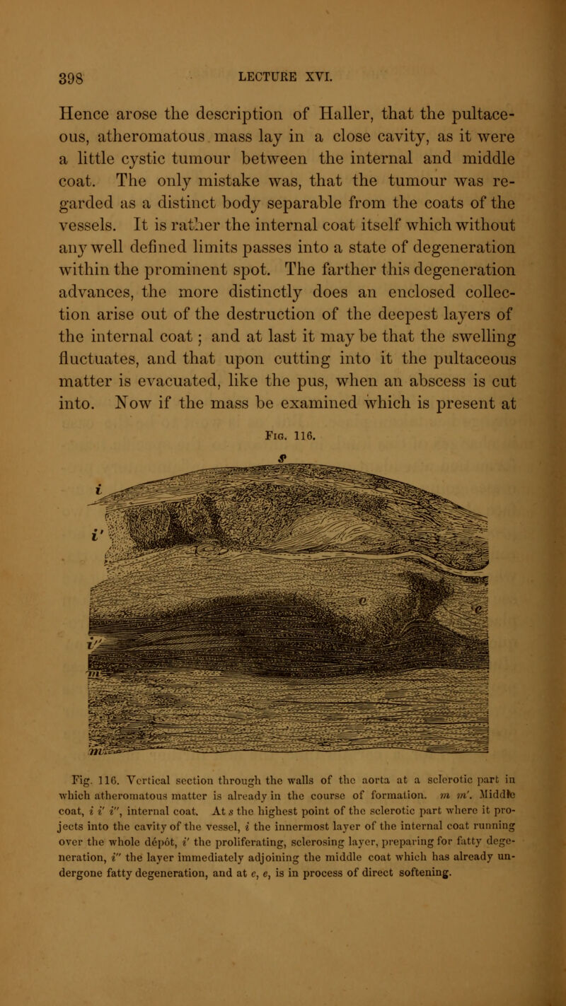 Hence arose the description of Haller, that the pultace- ous, atheromatous mass lay in a close cavity, as it were a little cystic tumour between the internal and middle coat. The only mistake was, that the tumour was re- garded as a distinct body separable from the coats of the vessels. It is rather the internal coat itself which without any well defined limits passes into a state of degeneration within the prominent spot. The farther this degeneration advances, the more distinctly does an enclosed collec- tion arise out of the destruction of the deepest layers of the internal coat; and at last it may be that the swelling fluctuates, and that upon cutting into it the pultaceous matter is evacuated, like the pus, when an abscess is cut into. Now if the mass be examined which is present at Fig. 116. .WMS Fig. 116. Vertical section through the walls of the aorta at a sclerotic part in which atheromatous matter is already in the course of formation, m m'. Middfre coat, i i' i, internal coat. At s the highest point of the sclerotic part where it pro- jects into the cavity of the vessel, i the innermost layer of the internal coat running over the whole depot, i' the proliferating, sclerosing layer, preparing for fatty dege- neration, i the layer immediately adjoining the middle coat which has already un- dergone fatty degeneration, and at e, e, is in process of direct softening.