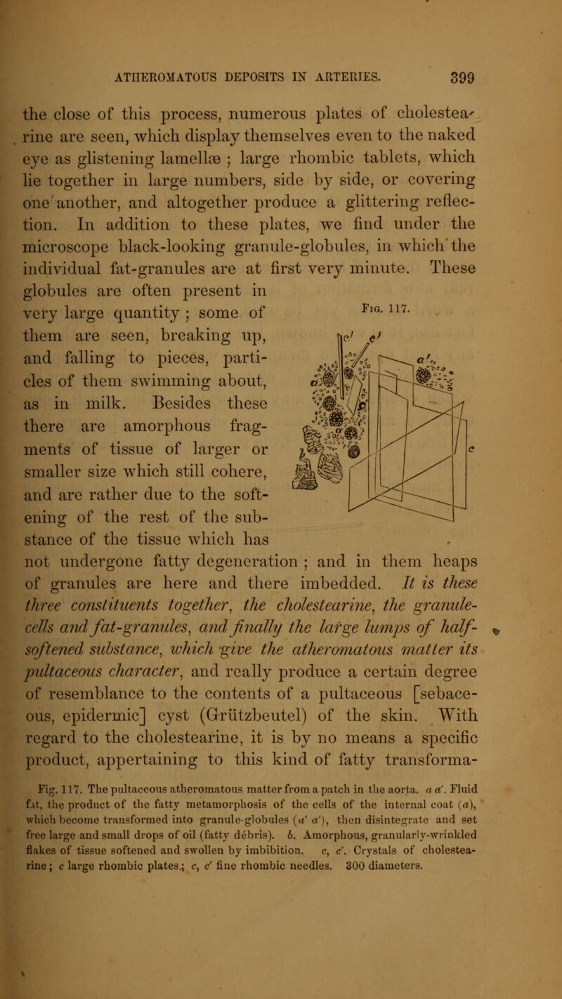 Fig. 117. the close of this process, numerous plates of cholestea' rine are seen, which display themselves even to the naked eye as glistening lamellae ; large rhombic tablets, which lie together in large numbers, side by side, or covering one another, and altogether produce a glittering reflec- tion. In addition to these plates, we find under the microscope black-looking granule-globules, in which'the individual fat-granules are at first very minute. These globules are often present in very large quantity ; some of them are seen, breaking up, and falling to pieces, parti- cles of them swimming about, as in milk. Besides these there are amorphous frag- ments of tissue of larger or smaller size which still cohere, and are rather due to the soft- ening of the rest of the sub- stance of the tissue which has not undergone fatty degeneration ; and in them heaps of granules are here and there imbedded. It is these three constituents together, the cholestearine, the granule- cells and fat-granules, and finally the large lumps of half- softened substance, which give the atheromatous matter its pultaceous character, and really produce a certain degree of resemblance to the contents of a pultaceous [sebace- ous, epidermic] cyst (Griitzbeutel) of the skin. With regard to the cholestearine, it is by no means a specific product, appertaining to this kind of fatty transforma- Fig. 117. The pultaceous atheromatous matter from a patch in the aorta, a a'. Fluid fit, the product of the fatty metamorphosis of the cells of the internal coat (a), which become transformed into granule-globules (a'a'), then disintegrate and set free large and small drops of oil (fatty debris), b. Amorphous, granularly-wrinkled flakes of tissue softened and swollen by imbibition. c, c'. Crystals of cholestea- rine; c large rhombic plates.; c, c' fine rhombic needles. 300 diameters.