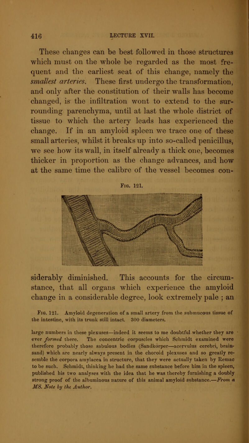These changes can be best followed in those structures which must on the whole be regarded as the most fre- quent and the earliest seat of this change, namely the smallest arteries. These first undergo the transformation, and only after the constitution of their walls has become changed, is the infiltration wont to extend to the sur- rounding parenchyma, until at last the whole district of tissue to which the artery leads has experienced the change. If in an amyloid spleen we trace one of these small arteries, whilst it breaks up into so-called penicillus, we see how its wall, in itself already a thick one, becomes thicker in proportion as the change advances, and how at the same time the calibre of the vessel becomes con- Fig. 121. siderably diminished. This accounts for the circum- stance, that all organs which experience the amyloid change in a considerable degree, look extremely pale ; an Fig. 121. Amyloid degeneration of a small artery from the submucous tissue of the intestine, with its trunk still intact. 300 diameters. large numbers in these plexuses—indeed it seems to me doubtful whether they are ever formed there. The concentric corpuscles which Schmidt examined were therefore probably those sabulous bodies (Sandkorper—acervulus cerebri, brain- sand) which are nearly always present in the choroid plexuses and so greatly re- semble the corpora amylacea in structure, that they were actually taken by Remac to be such. Schmidt, thinking he had the same substance before him in the spleen, published his two analyses with the idea that he was thereby furnishing a doubly strong proof of the albuminous nature of this animal amyloid substance.—From a MS. Note by the Author.