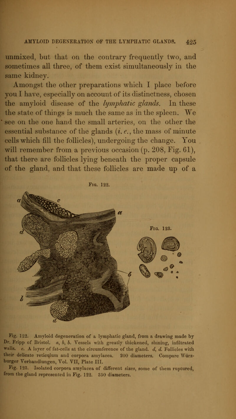 unmixed, but that on the contrary frequently two, and sometimes all three, of them exist simultaneously in the same kidney. Amongst the other preparations which I place before you I have, especially on account of its distinctness, chosen the amyloid disease of the lymphatic glands. In these the state of things is much the same as in the spleen. We see on the one hand the small arteries, on the other the essential substance of the glands (i. e., the mass of minute cells which fill the follicles), undergoing the change. You will remember from a previous occasion (p. 208, Fig. 61), that there are follicles lying beneath the proper capsule of the gland, and that these follicles are made up of a Fig. 122. Fig. 122. Amyloid degeneration of a lymphatic gland, from a drawing made by Dr. Fripp of Bristol, a, b, b. Vessels with greatly thickened, shining, infiltrated walls, e. A layer of fat-cells at the circumference of the gland, d, d. Follicles with their delicate reticulum and corpora amylacea. 200 diameters. Compare Wurz- burger Verhandlungen, Vol. VII, Plate III. Fig. 123. Isolated corpora amylacea of different sizes, some of them ruptured, from the gland represented in Fig. 122. 350 diameters.