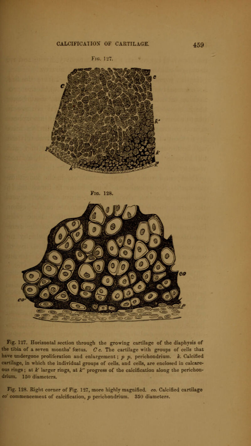 CALCIFICATION* OF CARTILAGE. Fig. 127. Fig. 128. CO Fig. 127. Horizontal section through the growing cartilage of the diaphysis of the tibia of a seven months' foetus. C c. The cartilage with groups of cells that have undergone proliferation and enlargement; p p, perichondrium, k. Calcified cartilage, in which the individual groups of cells, and cells, are enclosed in calcare- ous rings; at lc' larger rings, at lc progress of the calcification along the perichon- drium. 150 diameters. Fig. 128. Right corner of Fig. 127, more highly magnified, co. Calcified cartilage co' commencement of calcification, p perichondrium. 350 diameters.