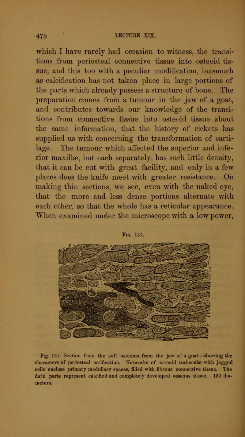 which I have rarely had occasion to witness, the transi- tions from periosteal connective tissue into osteoid tis- sue, and this too with a peculiar modification, inasmuch as calcification has not taken place in large portions of the parts which already possess a structure of bone. The preparation comes from a tumour in the jaw of a goat, and contributes towards our knowledge of the transi- tions from connective tissue into osteoid tissue about the same information, that the history of rickets has supplied us with concerning the transformation of carti- lage. The tumour which affected the superior and infe- rior maxillae, but each separately, has such little density, that it can be cut with great facility, and only in a few places does the knife meet with greater resistance. On making thin sections, we see, even with the naked eye, that the more and less dense portions alternate with each other, so that the whole has a reticular appearance. When examined under the microscope with a low power, Fig. 131. *^^/^ Fig. 181. Section from the sofc osteoma from the jaw of a goat—showing the characters of periosteal ossification. Networks of osteoid trabecules with jagged cells enclose primary medullary spaces, filled with fibrous connective tissue. The dark parts represent calcified and completely developed osseous tissue. 150 dia- meters.