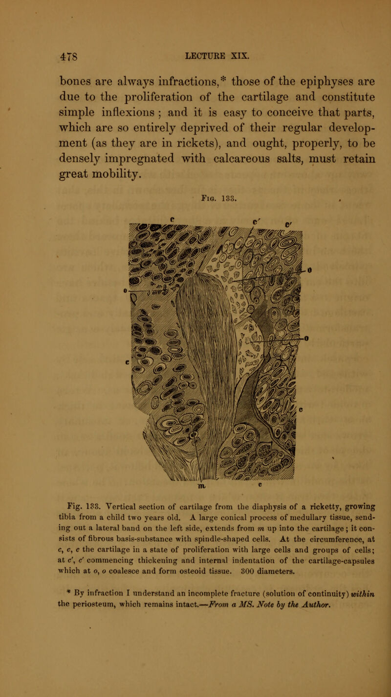 bones are always infractions,* those of the epiphyses are due to the proliferation of the cartilage and constitute simple inflexions ; and it is easy to conceive that parts, which are so entirely deprived of their regular develop- ment (as they are in rickets), and ought, properly, to be densely impregnated with calcareous salts, must retain great mobility. Fig. 133. ?A IflliB M1B Fig. 133. Vertical section of cartilage from the diaphysis of a ricketty, growing tibia from a child two years old. A large conical process of medullary tissue, send- ing out a lateral band on the left side, extends from m up into the cartilage; it con- sists of fibrous basis-substance with spindle-shaped cells. At the circumference, at c, c, c the cartilage in a state of proliferation with large cells and groups of cells; at c\ c' commencing thickening and internal indentation of the cartilage-capsules which at o, o coalesce and form osteoid tissue. 300 diameters. * By infraction I understand an incomplete fracture (solution of continuity) within the periosteum, which remains intact.—From a MS. Note by the Author.