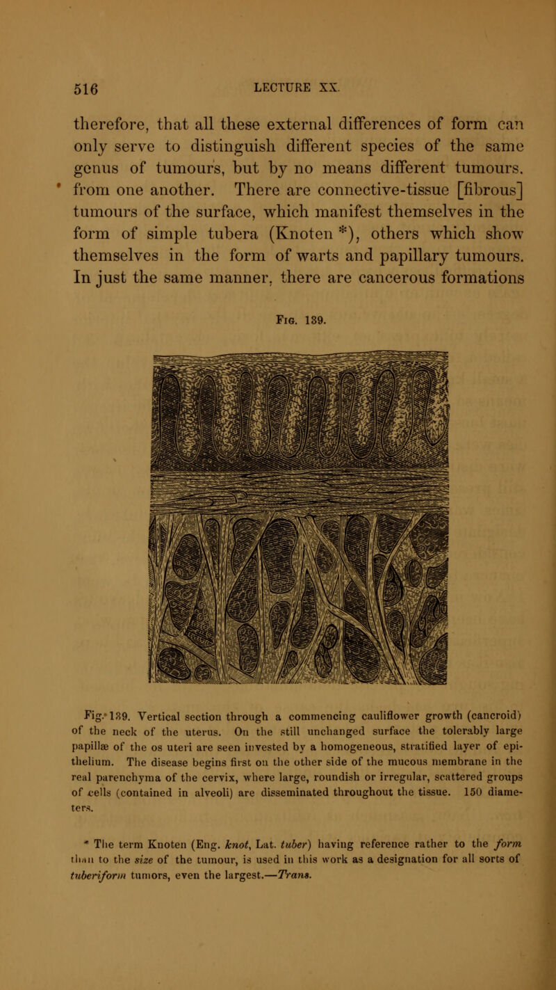 therefore, that all these external differences of form can only serve to distinguish different species of the same genus of tumours, but by no means different tumours, from one another. There are connective-tissue [fibrous] tumours of the surface, which manifest themselves in the form of simple tubera (Knoten *), others which show themselves in the form of warts and papillary tumours. In just the same manner, there are cancerous formations Fig. 139. Fig.'139. Vertical section through a commencing cauliflower growth (cancroid) of the neck of the uterus. On the still unchanged surface the tolerably large papillae of the os uteri are seen invested by a homogeneous, stratified layer of epi- thelium. The disease begins first on the other side of the mucous membrane in the real parenchyma of the cervix, where large, roundish or irregular, scattered groups of cells (contained in alveoli) are disseminated throughout the tissue. 150 diame- ters. * The term Knoten (Eng. knot, Lat. tuber) having reference rather to the form than to the size of the tumour, is used in this work as a designation for all sorts of tuberiform tumors, even the largest.—Trans.