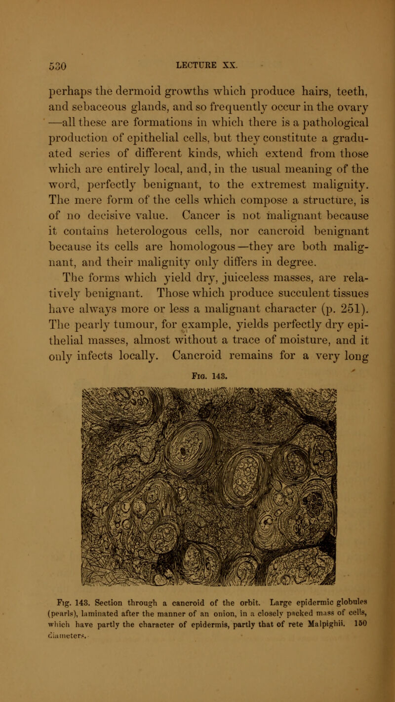 perhaps the dermoid growths which produce hairs, teeth, and sebaceous glands, and so frequently occur in the ovary —all these are formations in which there is a pathological production of epithelial cells, but they constitute a gradu- ated series of different kinds, which extend from those which are entirely local, and, in the usual meaning of the word, perfectly benignant, to the extremest malignity. The mere form of the cells which compose a structure, is of no decisive value. Cancer is not malignant because it contains heterologous cells, nor cancroid benignant because its cells are homologous—they are both malig- nant, and their malignity only differs in degree. The forms which yield dry, juiceless masses, are rela- tively benignant. Those which produce succulent tissues have always more or less a malignant character (p. 251). The pearly tumour, for example, yields perfectly dry epi- thelial masses, almost without a trace of moisture, and it only infects locally. Cancroid remains for a very long Fig. 143. Fig. 143. Section through a cancroid of the orbit. Large epidermic globules (pearls), laminated after the manner of an onion, in a closely packed mass of cells, which have partly the character of epidermis, partly that of rete Malpighii. 150 diameter*.