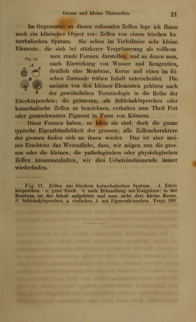 Im Gegensätze zu diesen colossalen Zellen lege ich Ihnen noch ein klinisches Ohject vor: Zellen von einem frischen ka tarrhalischen Sputum. Sie sehen im Verhältniss sehr kleine Elemente, die sich hei stärkerer Vergrösserung als vollkom- Fi men runde Formen darstellen, und an denen man, A nacli Einwirkung von Wasser und Reagentien, dk (S&\ deutlich eine Membran, Kerne und einen im fri- l b ^ sehen Zustande trüben Inhalt unterscheidet. Die $£$ meisten von den kleinen Elementen gehören nach L der gewöhnlichen Terminologie in die Reihe der Eiterkörperchen; die grösseren, als Schleimkörperchen oder katarrhalische Zellen zu bezeichnen, enthalten zum Theil Fett oder grauschwarzes Pigment in Form von Körnern. Diese Formen haben, so klein sie sind, doch die ganze typische Eigenthumlichkeit der grossen; alle Zellencharaktere der grossen finden sich an ihnen wieder. Das ist aber mei- nes Erachtens das Wesentliche, dass, wir mögen nun die gros- sen oder die kleinen, die pathologischen oder physiologischen Zellen zusammenhalten, wir dies Uebereinstimmende immer wiederfinden. Fig. 11. Zellen aus frischem katarrhalischen Sputum. A. Eiter- körperchen. a. ganz frisch, b. nach Behandlung mit Essigsäure: in der Membran ist der Inhalt aufgeklart und man sieht drei kleine Kerne. B. Schleimkörperchen. a. einfaches, b. mit Pigmentkörnchen. Vergr. 300. 4