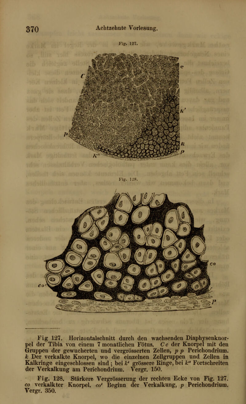 Fi?. 127. SAB? Fi*. 128. CO Fig 127. Horizontalschnitt durch den wachsenden Diaphysenknor- pel der Tibia von einem 7 monatlichen Fötus. C c der Knorpel mit den Gruppen der gewucherten und vergrüsserten Zellen, p p Perichondrium. k Der verkalkte Knorpel, wo die einzelnen Zellgruppen und Zellen in Kalkringe eingeschlossen sind ; bei k' grössere Ringe, bei k Fortschreiten der Verkalkung am Perichondrium. Vergr. 150. Fig. 128. Stärkere Vergrösserung der rechten Ecke von Fig. 127. co verkalkter Knorpel, co' Beginn der Verkalkung, p Perichondrium. Vergr. 350.