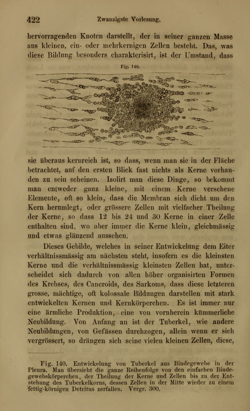 hervorragenden Knoten darstellt, der in seiner ganzen Masse aus kleinen, ein- oder mehrkernigen Zellen besteht. Das, was diese Bildung besonders charakterisirt, ist der Umstand, dass Fi-. 140. ' T^n_ ^&5^ sie überaus kernreich ist, so dass, wenn man sie in der Flache betrachtet, auf den ersten Blick fast nichts als Kerne vorhan- den zu sein scheinen. Isolirt man diese Dinge, so bekommt man entweder ganz kleine, mit einem Kerne versehene Elemente, oft so klein, dass die Membran sich dicht um den Kern herumlegt, oder grössere Zellen mit vielfacher Theilung der Kerne, so dass 12 bis 24 und 30 Kerne in einer Zelle enthalten sind, wo aber immer die Kerne klein, gleichmässig und etwas glänzend aussehen. Dieses Gebilde, welches in seiner Entwickelung dem Eiter verhältnissmässig am nächsten steht, insofern es die kleinsten Kerne und die verhältnissmässig kleinsten Zellen hat, unter- scheidet sich dadurch von allen höher organisirten Formen des Krebses, des Cancroids, des Sarkoms, dass diese letzteren grosse, mächtige, oft kolossale Bildungen darstellen mit stark entwickelten Kernen und Kernkörpereken. Es ist immer nur eine ärmliche Produktion, eine von vornherein kümmerliche Neubildung. Von Anfang an ist der Tuberkel, wie andere Neubildungen, von Gefässen durchzogen, allein wenn er sich vergrössert, so drängen sich seine vielen kleinen Zellen, diese, Fig. 140. Entwickelung von Tuberkel aus Bindegewebe in der Pleura. Man übersieht die ganze Reihenfolge von den einfachen Binde- gewebskörperchen, der Theilung der Kerne und Zellen bis zu der Ent- stehung des Tuberkelkorns, dessen Zellen in der Mitte wieder zu einem fettig-körnigen Detritus zerfallen. Vergr. 300.