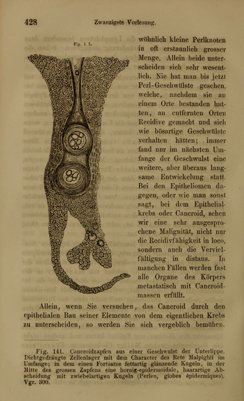 Fig. 11. wohnlich kleine Perlknoten in oft erstaunlich grosser Menge. Allein beide unter- scheiden sich sehr wesent- lich. Nie hat man bis jetzt Perl-Geschwülste gesehen, welche, nachdem sie an einem Orte bestanden hat- ten, an entfernten Orten Recidive gemacht und sich wie bösartige Geschwülste verhalten hätten; immer fand nur im nächsten Um- fange der Geschwulst eine weitere, aber überaus lang- same Entwickelung statt. Bei den Epitheliomen da- gegen, oder wie man sonst sagt, bei dem Epithelial- krebs oder Cancroid, sehen wir eine sehr ausgespro- chene Malignität, nicht nur die Recidivfähigkeit in loco, sondern auch die Verviel- fältigung in distans. In manchen Fällen werden fast alle Organe des Körpers metastatisch mit Cancroid- massen erfüllt. Allein, wenn Sie versuchen, das Cancroid durch den epithelialen Bau seiner Elemente von dem eigentlichen Krebs zu unterscheiden, so werden Sie sich vergeblich bemühen. Fig. 141. Cancroidzapfen aus einer Geschwulst der Unterlippe. Dichtgedrängte Zellenlager mit dem Character des Rete Malpighii im Umfange; in dem einen Fortsatze fettartig glänzende Kugeln, in der Mitte des grossen Zapfens eine hornig-epidermoidale, haarartige Ab- scheidung mit zwiebelartigen Kugeln (Perlen, globes epidermiques). Vgr. 300.