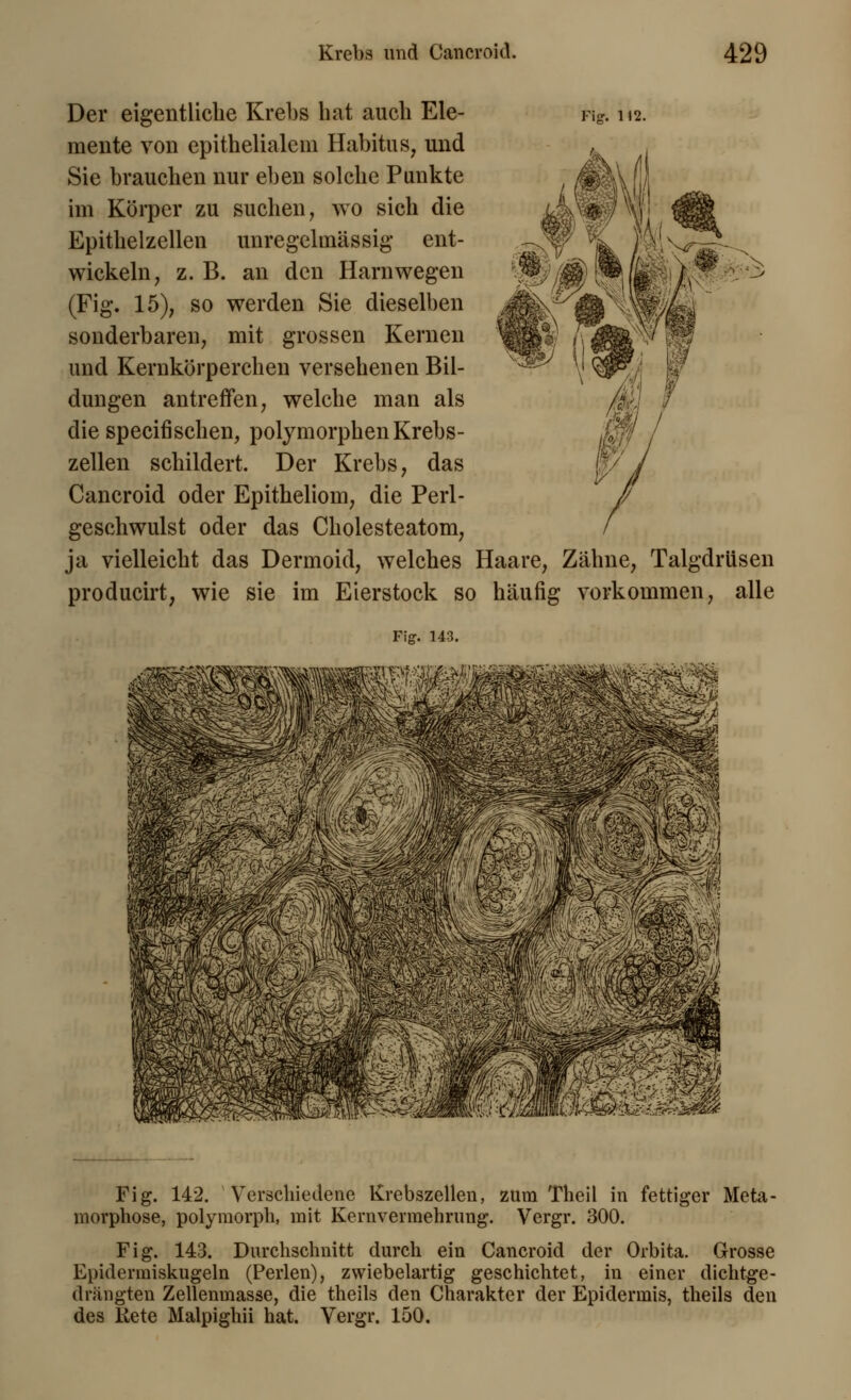 ,^s Der eigentliche Krebs bat auch Ele- Fig. 112. mente von epithelialem Habitus, und Sie brauchen nur eben solche Punkte im Körper zu suchen, wo sich die Epithelzellen unregelmässig ent- wickeln, z. B. an den Harnwegen (Fig. 15), so werden Sie dieselben sonderbaren, mit grossen Kernen und Kernkörperchen versehenen Bil- dungen antreffen, welche man als die speeifischen, polymorphen Krebs- zellen schildert. Der Krebs, das Cancroid oder Epitheliom, die Perl- geschwulst oder das Cholesteatom, ja vielleicht das Dermoid, welches Haare, Zähne, Talgdrüsen producirt, wie sie im Eierstock so häufig vorkommen, alle Fig. 143. Fig. 142. Verschiedene Krebszellen, zum Theil in fettiger Meta- morphose, polymorph, mit Kernvermehrung. Vergr. 300. Fig. 143. Durchschnitt durch ein Cancroid der Orbita. Grosse Epidermiskugeln (Perlen), zwiebelartig geschichtet, in einer dichtge- drängten Zellenmasse, die theils den Charakter der Epidermis, theils den des Kete Malpighii hat. Vergr. 100.