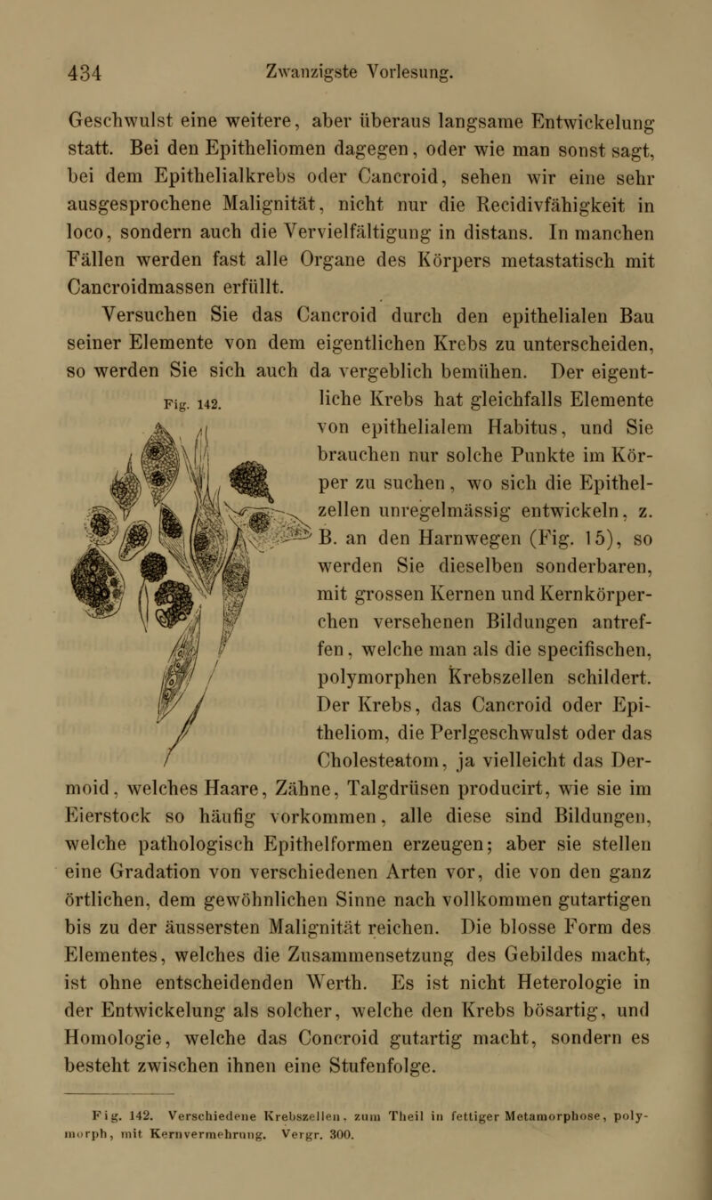 Fig. 142. ;N Geschwulst eine weitere, aber überaus langsame Entwicklung statt. Bei den Epitheliomen dagegen, oder wie man sonst sagt, bei dem Epithelialkrebs oder Cancroid, sehen wir eine sehr ausgesprochene Malignität, nicht nur die Recidivfähigkeit in loco, sondern auch die Vervielfältigung in distans. In manchen Fällen werden fast alle Organe des Körpers metastatisch mit Cancroidmassen erfüllt. Versuchen Sie das Cancroid durch den epithelialen Bau seiner Elemente von dem eigentlichen Krebs zu unterscheiden, so werden Sie sich auch da vergeblich bemühen. Der eigent- liche Krebs hat gleichfalls Elemente von epithelialem Habitus, und Sie brauchen nur solche Punkte im Kör- per zu suchen, wo sich die Epithel- zellen unregelmässig entwickeln, z. B. an den Harnwegen (Fig. 15), so werden Sie dieselben sonderbaren, mit grossen Kernen und Kern körper- chen versehenen Bildungen antref- fen , welche man als die specifischen, polymorphen Krebszellen schildert. Der Krebs, das Cancroid oder Epi- theliom, die Perlgeschwulst oder das Cholesteatom, ja vielleicht das Der- moid, welches Haare, Zähne, Talgdrüsen producirt, wie sie im Eierstock so häufig vorkommen, alle diese sind Bildungen, welche pathologisch Epithelformen erzeugen; aber sie stellen eine Gradation von verschiedenen Arten vor, die von den ganz örtlichen, dem gewöhnlichen Sinne nach vollkommen gutartigen bis zu der äussersten Malignität reichen. Die blosse Form des Elementes, welches die Zusammensetzung des Gebildes macht, ist ohne entscheidenden Werth. Es ist nicht Heterologie in der Entwickelung als solcher, welche den Krebs bösartig, und Homologie, welche das Concroid gutartig macht, sondern es besteht zwischen ihnen eine Stufenfolge. Fig. 142. Verschiedene Krebszellen, zum Theil in fettiger Metamorphose, poly- morph, mit Kernvermehrnng. Vergr. 300.