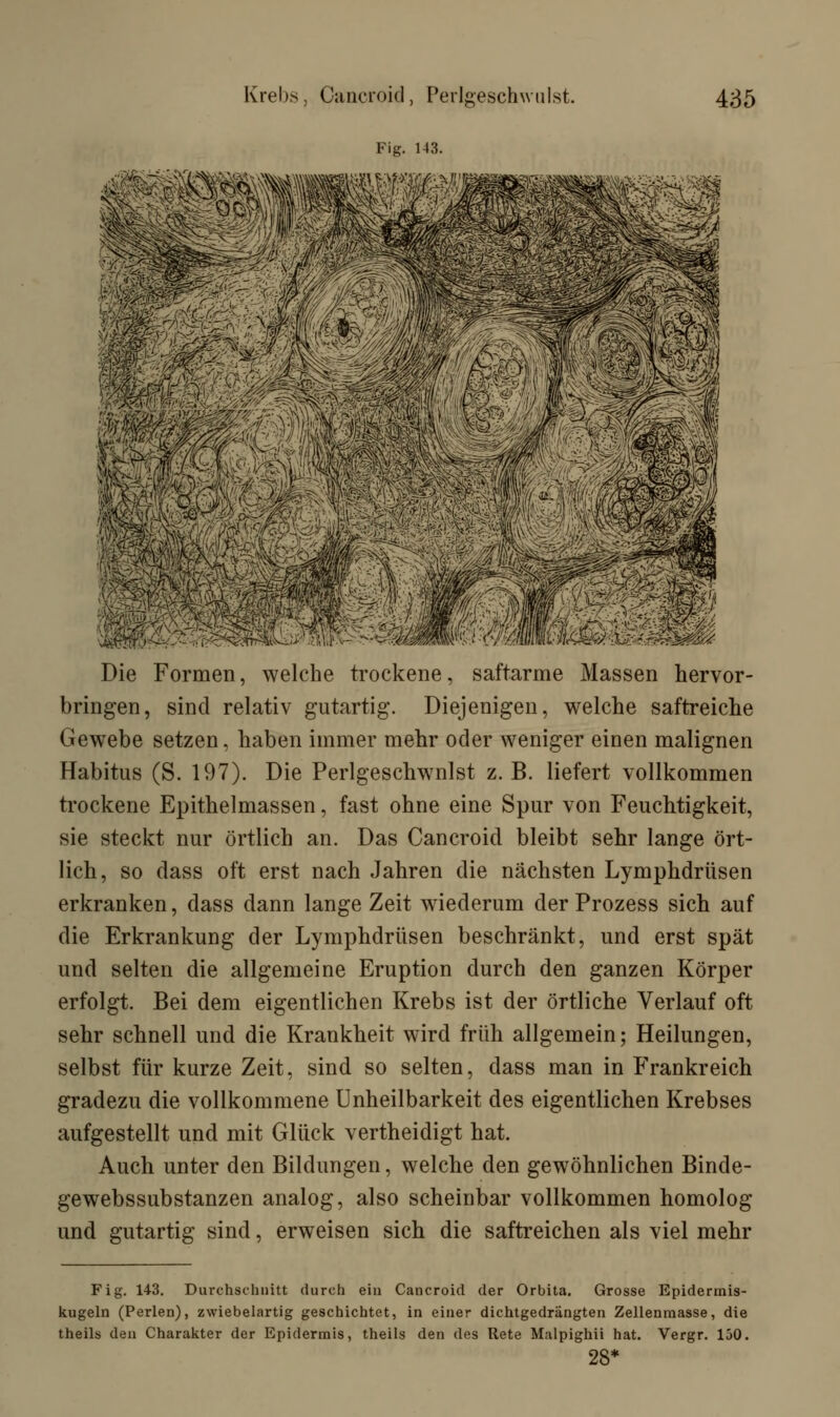 Fig. 143. Die Formen, welche trockene, saftarme Massen hervor- bringen, sind relativ gutartig. Diejenigen, welche saftreiche Gewebe setzen, haben immer mehr oder weniger einen malignen Habitus (S. 197). Die Perlgeschwnlst z.B. liefert vollkommen trockene Epithelmassen, fast ohne eine Spur von Feuchtigkeit, sie steckt nur örtlich an. Das Cancroid bleibt sehr lange ört- lich, so dass oft erst nach Jahren die nächsten Lymphdrüsen erkranken, dass dann lange Zeit wiederum der Prozess sich auf die Erkrankung der Lymphdrüsen beschränkt, und erst spät und selten die allgemeine Eruption durch den ganzen Körper erfolgt. Bei dem eigentlichen Krebs ist der örtliche Verlauf oft sehr schnell und die Krankheit wird früh allgemein; Heilungen, selbst für kurze Zeit, sind so selten, dass man in Frankreich gradezu die vollkommene Unheilbarkeit des eigentlichen Krebses aufgestellt und mit Glück vertheidigt hat. Auch unter den Bildungen, welche den gewöhnlichen Binde- gewebssubstanzen analog, also scheinbar vollkommen homolog und gutartig sind, erweisen sich die saftreichen als viel mehr Fig. 143. Durchschnitt durch ein Cancroid der Orbita. Grosse Epidermis- kugeln (Perlen), zwiebelartig geschichtet, in einer dichtgedrängten Zellenmasse, die theils den Charakter der Epidermis, theils den des Rete Malpighii hat. Vergr. 130. 28*