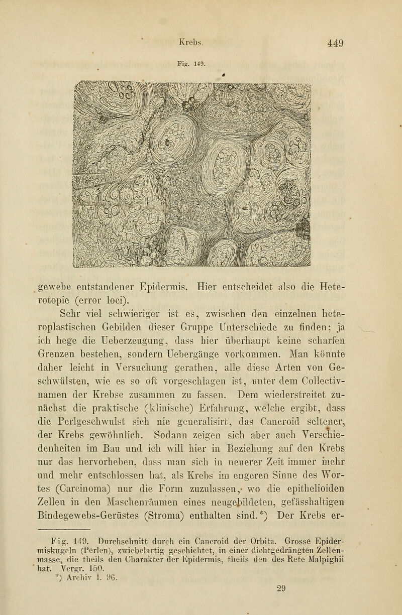 Fig. 149. r-S?£ C <Ä &?iM -.ä gewebe entstandener Epidermis. Hier entscheidet also die Hete- rotopie (error loci). Sehr viel schwieriger ist es, zwischen den einzelnen hete- roplastischen Gebilden dieser Gruppe Unterschiede zu finden; ja ich hege die Ueberzeugung, dass hier überhaupt keine scharfen Grenzen bestehen, sondern Uebergänge vorkommen. Man konnte daher leicht in Versuchung gerathen, alle diese Arten von Ge- schwülsten, wie es so oft vorgeschlagen ist, unter dem Collectiv- namen der Krebse zusammen zu fassen. Dem wiederstreitet zu- nächst die praktische (klinische) Erfahrung, welche ergibt, dass die Perlgeschwulst sich nie generalisirt, das Cancroid seltener, der Krebs gewöhnlich. Sodann zeigen sich aber auch Verschie- denheiten im Bau und ich will hier in Beziehung auf den Krebs nur das hervorheben, dass man sich in neuerer Zeit immer mehr und mehr entschlossen hat, als Krebs im engeren Sinne des Wor- tes (Carcinoma) nur die Form zuzulassen,- wo die epithelioiden Zellen in den Maschenräumen eines neugejjildeten, gefässhaltigen Bindegewebs-Gerüstes (Stroma) enthalten sind.*) Der Krebs er- Fig. 149. Durchschnitt durch ein Cancroid der Orbita. Grosse Epider- miskugeln (Perlen), zvvüebelartig geschichtet, in einer dichtgedrängten Zellen- masse, die theils den Charakter der Epidermis, theils den des Rete Malpighii hat. Vergr. 150. *) Archiv I. 96. 29