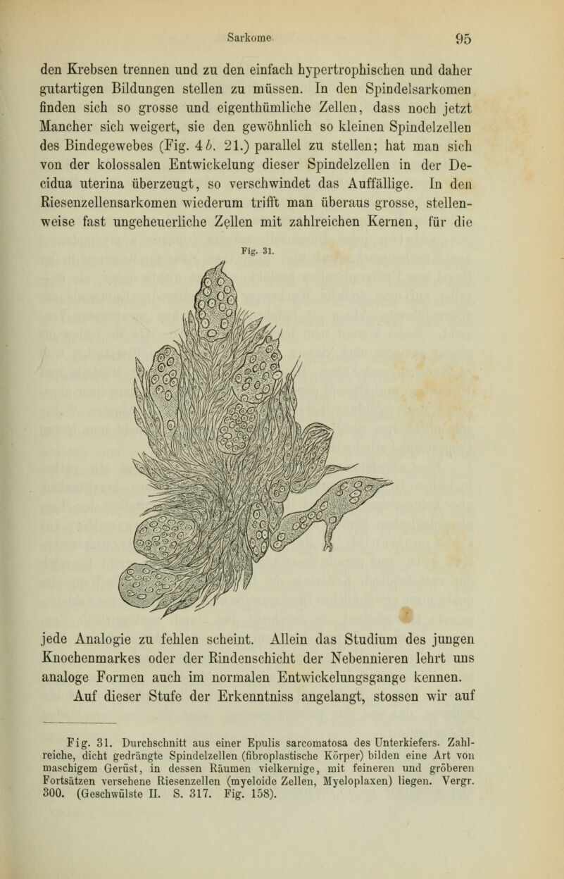 den Krebsen trennen und zu den einfach hypertrophischen und daher gutartigen Bildungen stellen zu müssen. In den Spindelsarkomen finden sich so grosse und eigenthümliche Zellen, dass noch jetzt Mancher sich weigert, sie den gewöhnlich so kleinen Spindelzellen des Bindegewebes (Fig. Ab. 21.) parallel zu stellen; hat man sich von der kolossalen Entwicklung dieser Spindelzellen in der De- cidua uterina überzeugt, so verschwindet das Auffällige. In den Riesenzellensarkomen wiederum trifft man überaus grosse, stellen- weise fast ungeheuerliche Zellen mit zahlreichen Kernen, für die Fig. 31. jede Analogie zu fehlen scheint. Allein das Studium des jungen Knochenmarkes oder der Rindenschicht der Nebennieren lehrt uns analoge Formen auch im normalen Entwickelungsgange kennen. Auf dieser Stufe der Erkenntniss angelangt, stossen wir auf Fig. 31. Durchschnitt aus einer Epulis sarcomatosa des Unterkiefers. Zahl- reiche, dicht gedrängte Spindelzellen (fibroplastische Körper) bilden eine Art von maschigem Gerüst, in dessen Räumen vielkernige, mit feineren und gröberen Fortsätzen versehene Riesenzellen (myeloide Zellen, Myeloplaxen) liegen. Vergr. 300. (Geschwülste II. S. 317. Fig. 158).