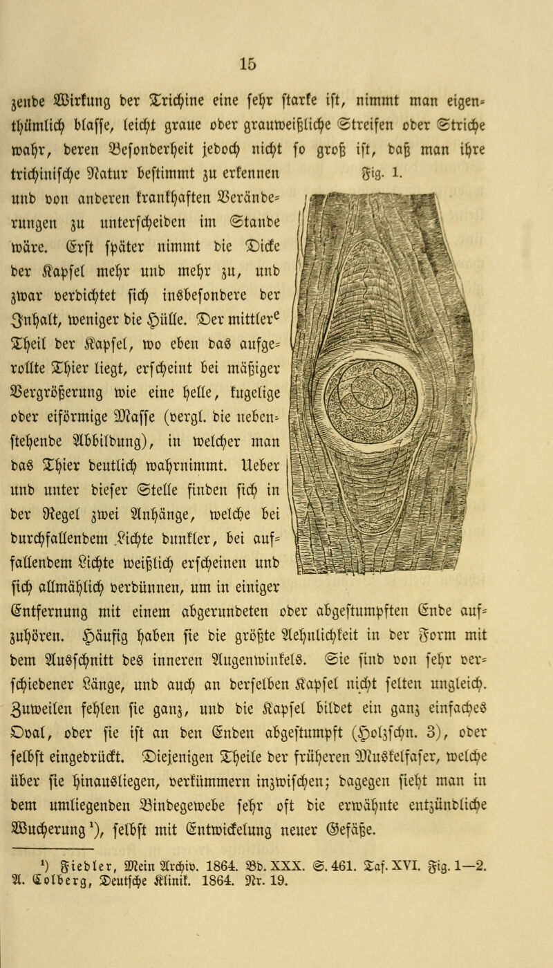 jenbe SBirfung ber £rid)tne eine fefyr ftarfe ift, nimmt man eigen» tl;ümlid? bfaffe, (etd;t graue ober grautoeißlicfye Streifen ober Striae toafyr, beren 23efonberfyeit jebocfy nicfyt fo groß iß, baß man tt)re trid;iuifcfye 9?atur beftimmt ju erfennen gig. 1. unb oon anberen t'rantfyaften 33eränbe= rungen ju unterfcfyeibcn im (Staube toäre. Gzrft f^äter nimmt bie SDtcfe ber ßapfet mefyr unb mefyr p, unb jtoar oerbicfytet ftety inSbefonbere ber ^nfycilt, toeniger bie §mlle. ©er mitttere 23jeil ber Zapfet, too eben ba$ aufge^ rollte £fyier liegt, erfcfyeint bei mäßiger Vergrößerung toie eine I)elie, fugelige ober eiförmige SD^affe (oergl. bie neben» ftefyenbe $Ibbilbung), in toetd;er man ba$ £fyier beuttid? toafyrnimmt. Ueber unb unter biefer ©teile ftnben fic^> in ber SRegel gtoei 5lnl)änge, toelcfye bei burcfyfaftenbem ,£icfyte buntTer, hü auf* fallenbem Sichte toeißlid) erfcfyeinen unb fid? allmäfytid) oerbünnen, um in einiger Entfernung mit einem abgerunbeten ober abgeftumfcften Gnbe auf* ju^ören. £)äufig fyaben fie bie größte 2lelmlid)feit in ber gorm mit bem $u$fd?nitt be$ inneren $Iugentoiufel$. ©ie finb oon fefyr oer= fcfyiebener Sänge, unb auefy an berfelben $apfel triebt feiten ungleich. 3moeilen fehlen fie ganj, unb bie ftapfel bilbet ein gan$ einfaches £)oal, ober fie ift an ben (Snben abgeftumpft ($ol3fcfyn. 3), ober fetbft eingebrüdt diejenigen Steile ber früheren $ht$feffafer, toelcfye über fie IjinauSltegen, oertummern injtoifcfyen; bagegen fielet man in bem umliegenben 33inbegetoebe fer)r oft bie ertoäl)nte ent$ünbtidj)e 2Bud?erung'), felbft mit (Suttoidelung neuer ®efäße. ') Siebter, 2>?ein 2lr$ifc. 1864 58b. XXX. ©.461. £af.XVI. gtg.l—2. 21. (Sotfcerg, Seutfc&e Ätinif. 1864 ^v. 19.