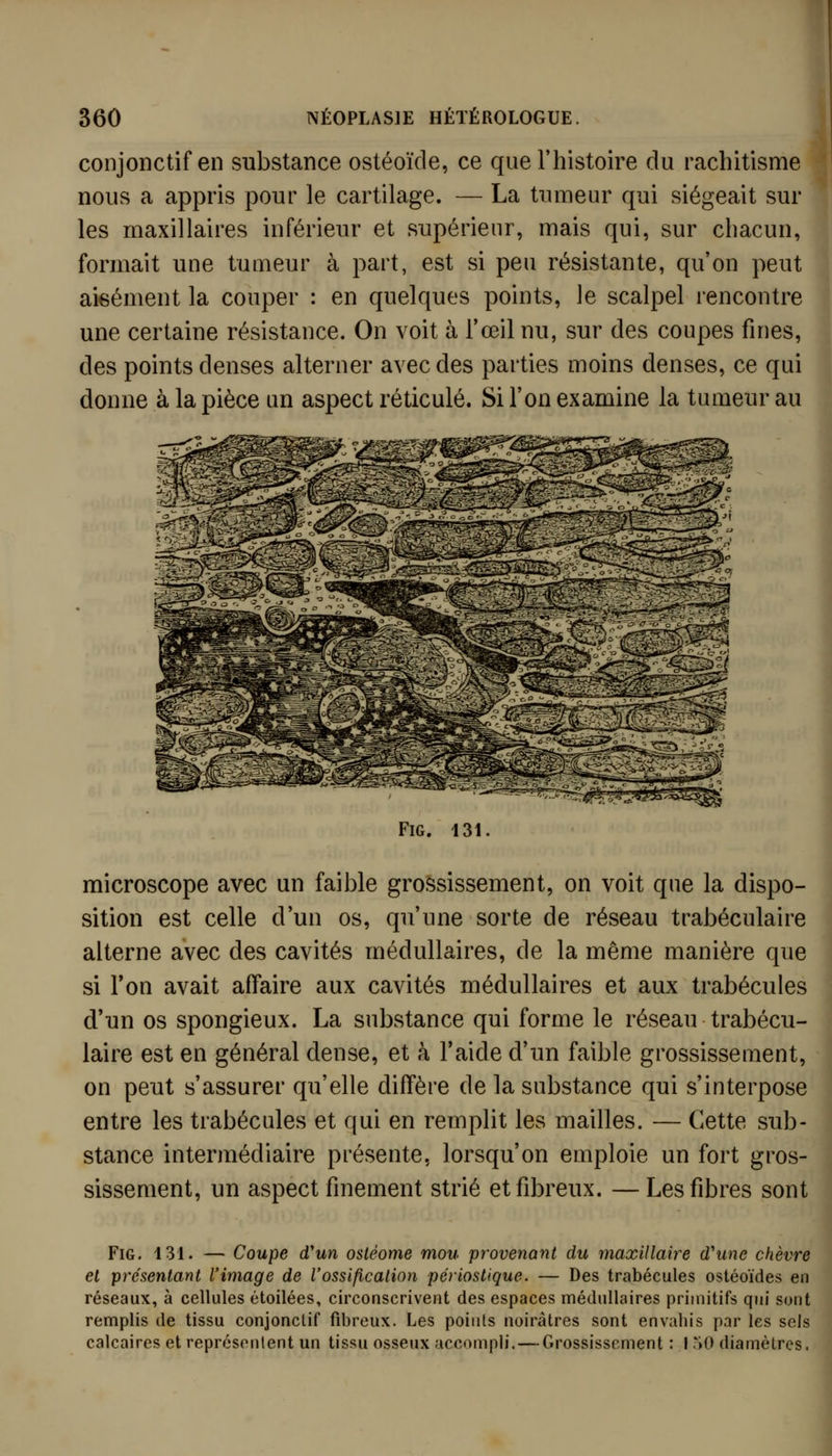 conjonctif en substance ostéoïde, ce que l'histoire du rachitisme nous a appris pour le cartilage. — La tumeur qui siégeait sur les maxillaires inférieur et supérieur, mais qui, sur chacun, formait une tumeur à part, est si peu résistante, qu'on peut aieément la couper : en quelques points, le scalpel rencontre une certaine résistance. On voit à l'œil nu, sur des coupes fines, des points denses alterner avec des parties moins denses, ce qui donne à la pièce un aspect réticulé. Si l'on examine la tumeur au I FiG. 131. microscope avec un faible grossissement, on voit que la dispo- sition est celle d'un os, qu'une sorte de réseau trabéculaire alterne avec des cavités médullaires, de la même manière que si l'on avait affaire aux cavités médullaires et aux trabécules d'un os spongieux. La substance qui forme le réseau trabécu- laire est en général dense, et à l'aide d'un faible grossissement, on peut s'assurer qu'elle diffère de la substance qui s'interpose entre les trabécules et qui en remplit les mailles. — Cette sub- stance intermédiaire présente, lorsqu'on emploie un fort gros- sissement, un aspect finement strié et fibreux. — Les fibres sont FiG. 131. — Coupe d'un osléome mou provenant du maxillaire d'une chèvre el présentant l'image de Vossification périostique. — Des trabécules ostéoïdes en réseaux, à cellules étoilées, circonscrivent des espaces médullaires primitifs qui sont remplis de tissu conjonctif fibreux. Les points noirâtres sont envahis par les sels calcaires et représentent un tissu osseux accompli.—Grossissement : I.^O diamètres. J