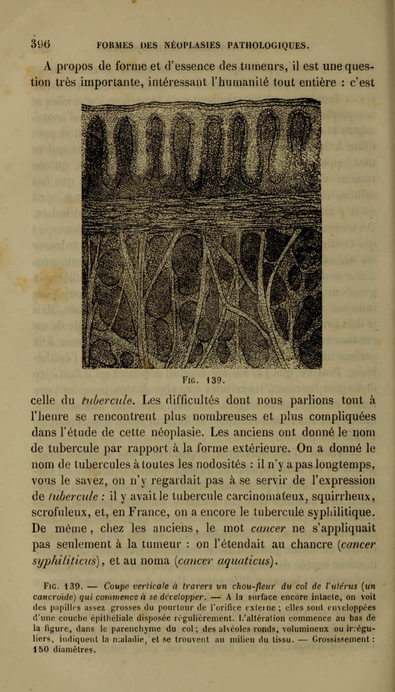 A propos de forme et d'essence des tumeurs, il est une ques- tion très importante, intéressant l'humanité tout entière : c'est FiG. 139. celle du tubercule. Les difficultés dont nous parlions tout à l'heure se rencontrent plus nombreuses et plus compliquées dans l'étude de cette néoplasie. Les anciens ont donné le nom de tubercule par rapport à la forme extérieure. On a donné le nom de tubercules à toutes les nodosités : il n'y a pas longtemps, vous le savez, on n'y regardait pas à se servir de l'expression de tubercule : il y avait le tubercule carcinomateux, squirrheux, scrofuleux, et, en France, on a encore le tubercule syphilitique. De même, chez les anciens, le mot cancer ne s'appliquait pas seulement à la tumeur : on l'étendait au chancre [cancer syphiliticus), et au noma [cancer aquaticus). FiG. 139. — Coupe verticale à h'avers un chou-fleur du col àe l'utérus [un cancroïde) qui commence à se développer. — A la surface encore intacte, on voit des papilles assez grosses du pourtour de l'orifice cxleine; elles sont enveloppées d'une couche épithéliale disposée régulièrement, i/allération commence au bas de la ligure, dans le parenchyme du col; des alvéoles ronds, volumineux ou ir:égu- liers, indiquent la maladie, et se trouvent au milieu du tissu. — Grossissement : 150 diamètres.