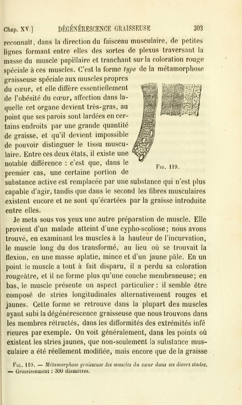 mWÊmffl Fig. 119. Chap. XV.] DÉGÉNÉRESCENCE GRAISSEUSE 303 reconnaît, dans la direction du faisceau musculaire, de petites lignes formant entre elles des sortes de plexus traversant la masse du muscle papillaire et tranchant sur la coloration rouge spéciale à ces muscles. C'est la forme type de la métamorphose graisseuse spéciale aux muscles propres du cœur, et elle diffère essentiellement de l'obésité du cœur, affection dans la- quelle cet organe devient très-gras, au point que ses parois sont lardées en cer- tains endroits par une grande quantité de graisse, et qu'il devient impossible de pouvoir distinguer le tissu muscu- laire. Entre ces deux états, il existe une notable différence : c'est que, dans le premier cas, une certaine portion de substance active est remplacée par une substance qui n'est plus capable d'agir, tandis que dans le second les fibres musculaires existent encore et ne sont qu'écartées par la graisse introduite entre elles. Je mets sous vos yeux une autre préparation de muscle. Elle provient d'un malade atteint d'une cypho-scoliose ; nous avons trouvé, en examinant les muscles à la hauteur de l'incurvation, le muscle long du dos transformé, au lieu où se trouvait la flexion, en une masse aplatie, mince et d'un jaune pâle. En un point le muscle a tout à fait disparu, il a perdu sa coloration rougeâtre, et il ne forme plus qu'une couche membraneuse; en bas, le muscle présente un aspect particulier : il semble être composé de stries longitudinales alternativement rouges et jaunes. Cette forme se retrouve dans la plupart des muscles ayant subi la dégénérescence graisseuse que nous trouvons dans les membres rétractés, dans les difformités des extrémités infé Heures par exemple. On voit généralement, dans les points où existent les stries jaunes, que non-seulement la substance mus- culaire a été réellement modifiée, mais encore que de la graisse Fig. 110. — Métamorphose graisseuse des muscles du cœur dans ses divers stades, — Grossissement : 300 diamètres.