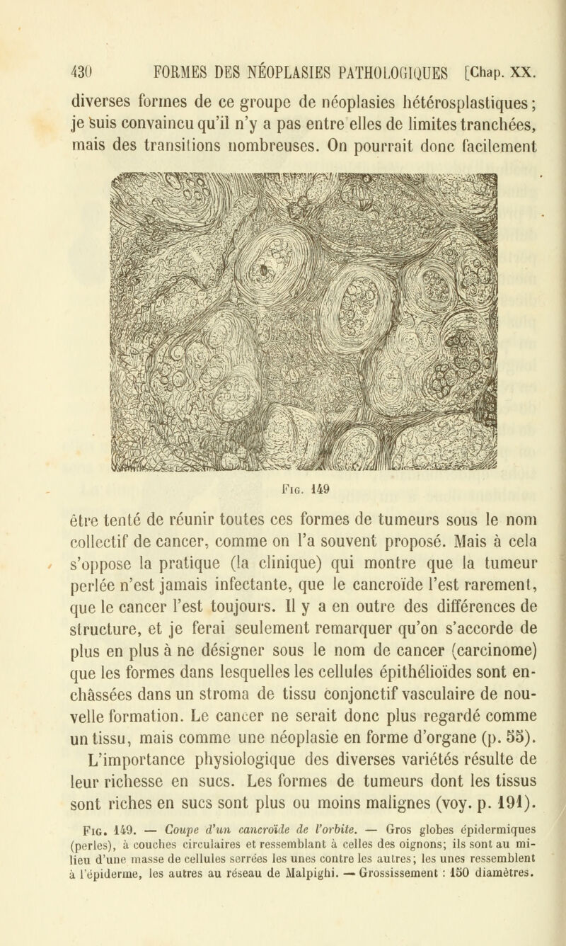 diverses formes de ce groupe de néoplasies hétérosplastiques ; je suis convaincu qu'il n'y a pas entre elles de limites tranchées, mais des transitions nombreuses. On pourrait donc facilement Fig. 149 être tenté de réunir toutes ces formes de tumeurs sous le nom collectif de cancer, comme on l'a souvent proposé. Mais à cela s'oppose la pratique (la clinique) qui montre que la tumeur perlée n'est jamais infectante, que le cancroïde l'est rarement, que le cancer l'est toujours. Il y a en outre des différences de structure, et je ferai seulement remarquer qu'on s'accorde de plus en plus à ne désigner sous le nom de cancer (carcinome) que les formes dans lesquelles les cellules épithélioïdes sont en- châssées dans un stroma de tissu conjonctif vasculaire de nou- velle formation. Le cancer ne serait donc plus regardé comme un tissu, mais comme une néoplasie en forme d'organe (p. 55). L'importance physiologique des diverses variétés résulte de leur richesse en sucs. Les formes de tumeurs dont les tissus sont riches en sucs sont plus ou moins malignes (voy. p. 191). Fig. 149. — Coupe d'un cancroïde de l'orbite. — Gros globes épidermiques (perles), à couches circulaires et ressemblant à celles des oignons; ils sont au mi- lieu d'une masse de cellules serrées les unes contre les autres; les unes ressemblent à l'épidémie, les autres au réseau de Malpighi. —Grossissement : 150 diamètres.