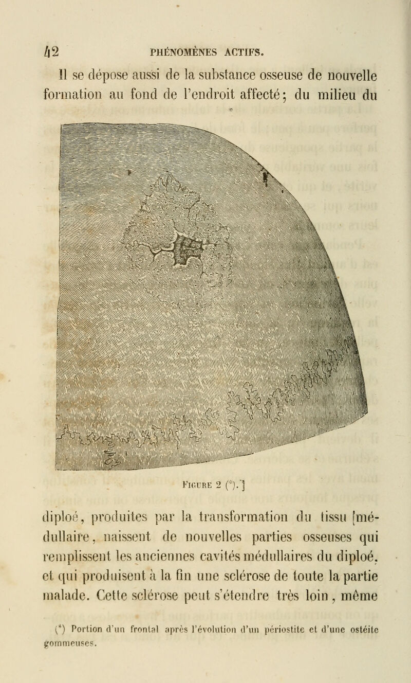 11 se dépose aussi de la substance osseuse de nouvelle formation au fond de l'endroit affecté ; du milieu du IL ^iiSP»* Figure 2 (*)/] diploé, produites par la transformation du tissu [mé- dullaire, naissent de nouvelles parties osseuses qui remplissent les anciennes cavités médullaires du diploé. et qui produisent à la fin une sclérose de toute la partie malade. Cette sclérose peut s'étendre très loin , môme (*) Portion d'un frontal après révolution O'un périostite et d'une ostéite gornmeuses.